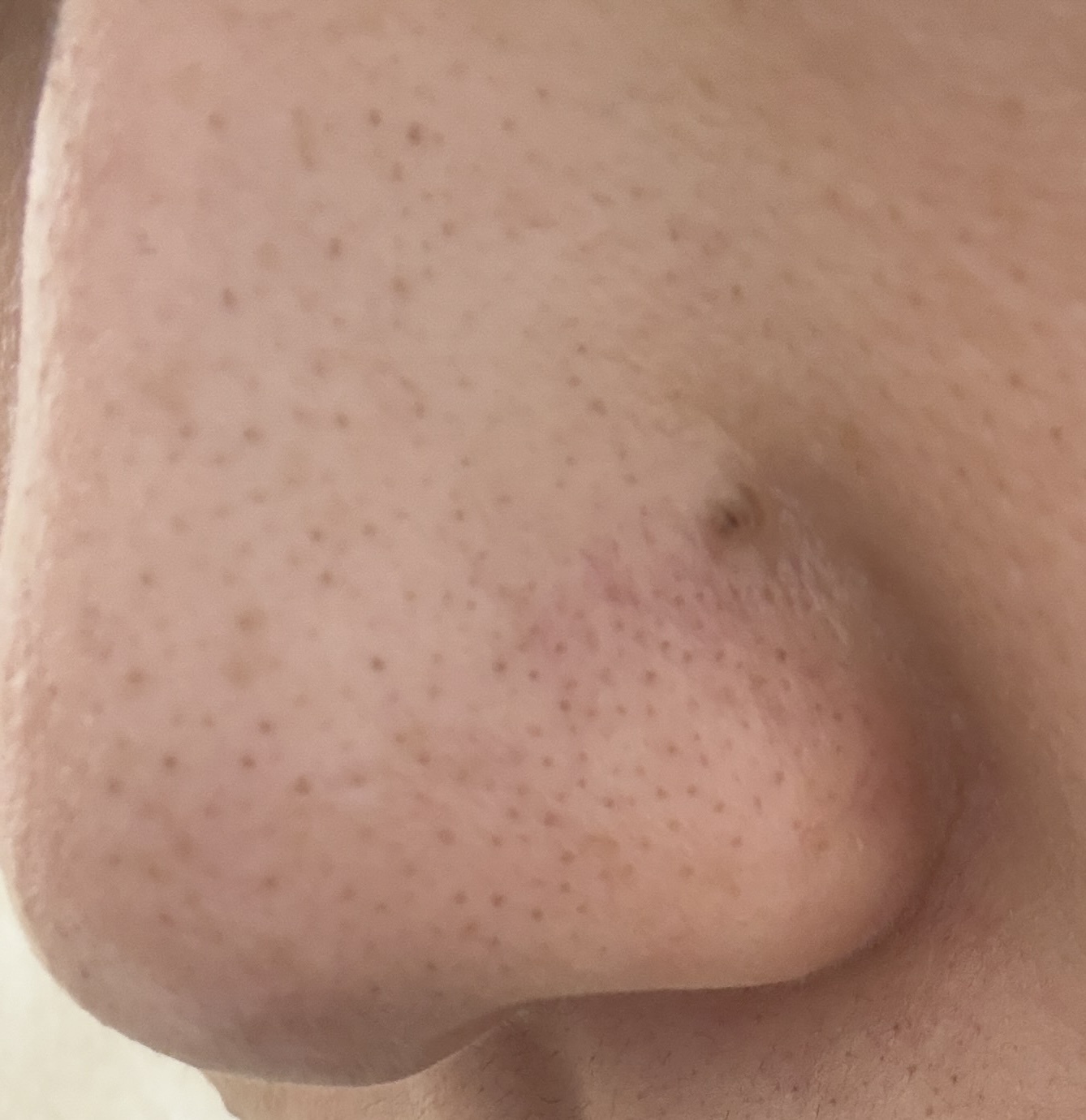 (写真あり)小鼻の黒ずみby 匿名さんの画像