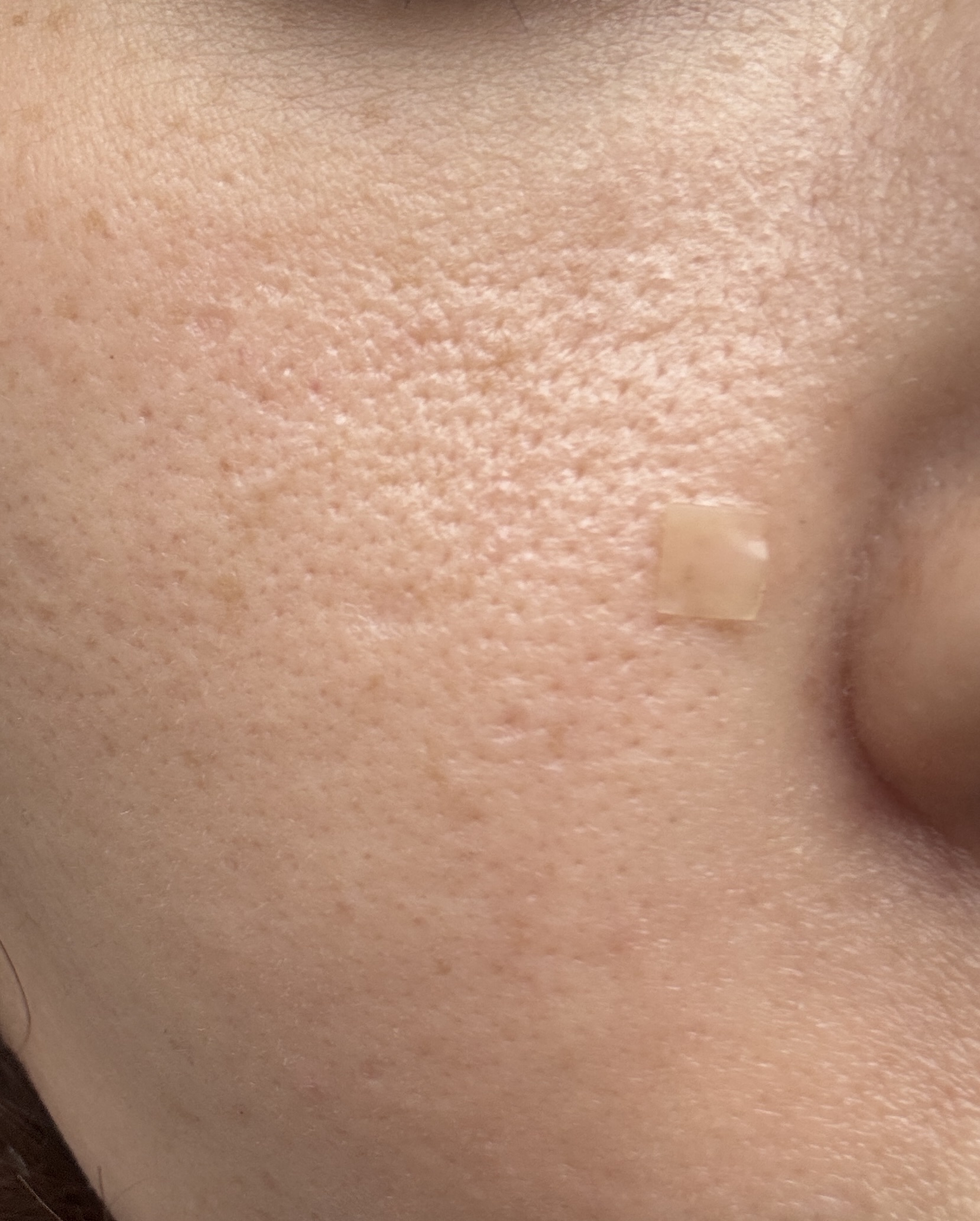 頬の毛穴について by 匿名さん の画像