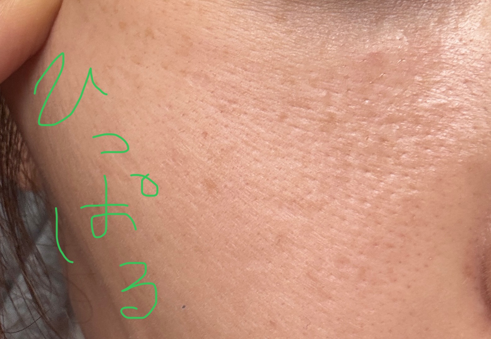 毛穴についてby 匿名さんの画像