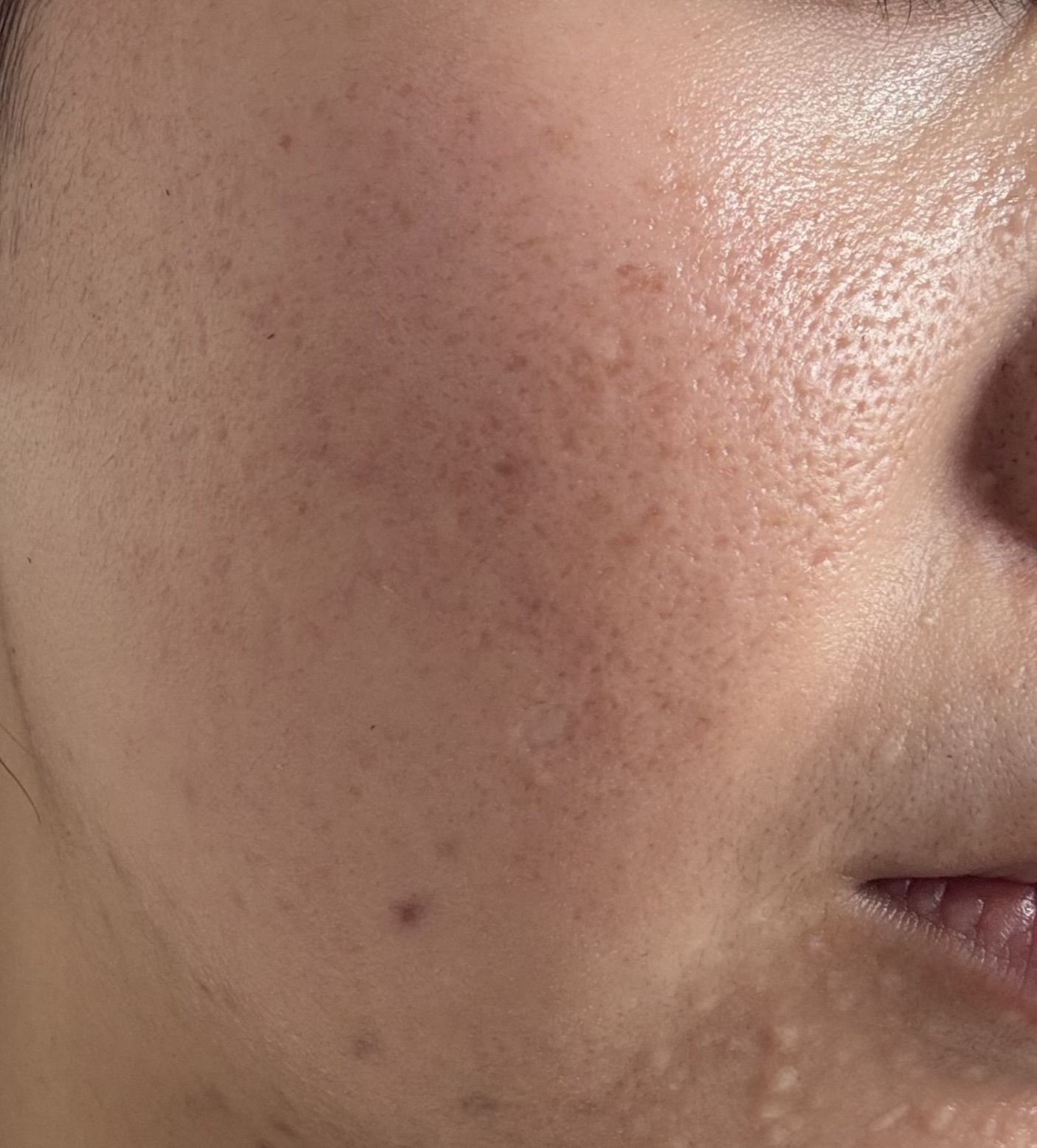 ニキビ跡、赤みが消えないです。 by りさりさ★☆さん の画像