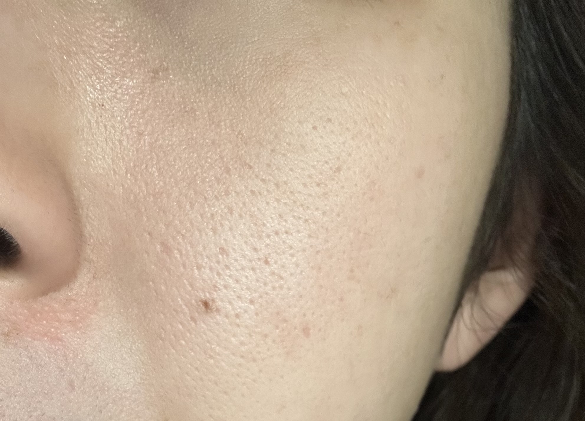 27歳です。肌が汚いので何とかしたいです。by ☆ころまるこ☆さんの画像