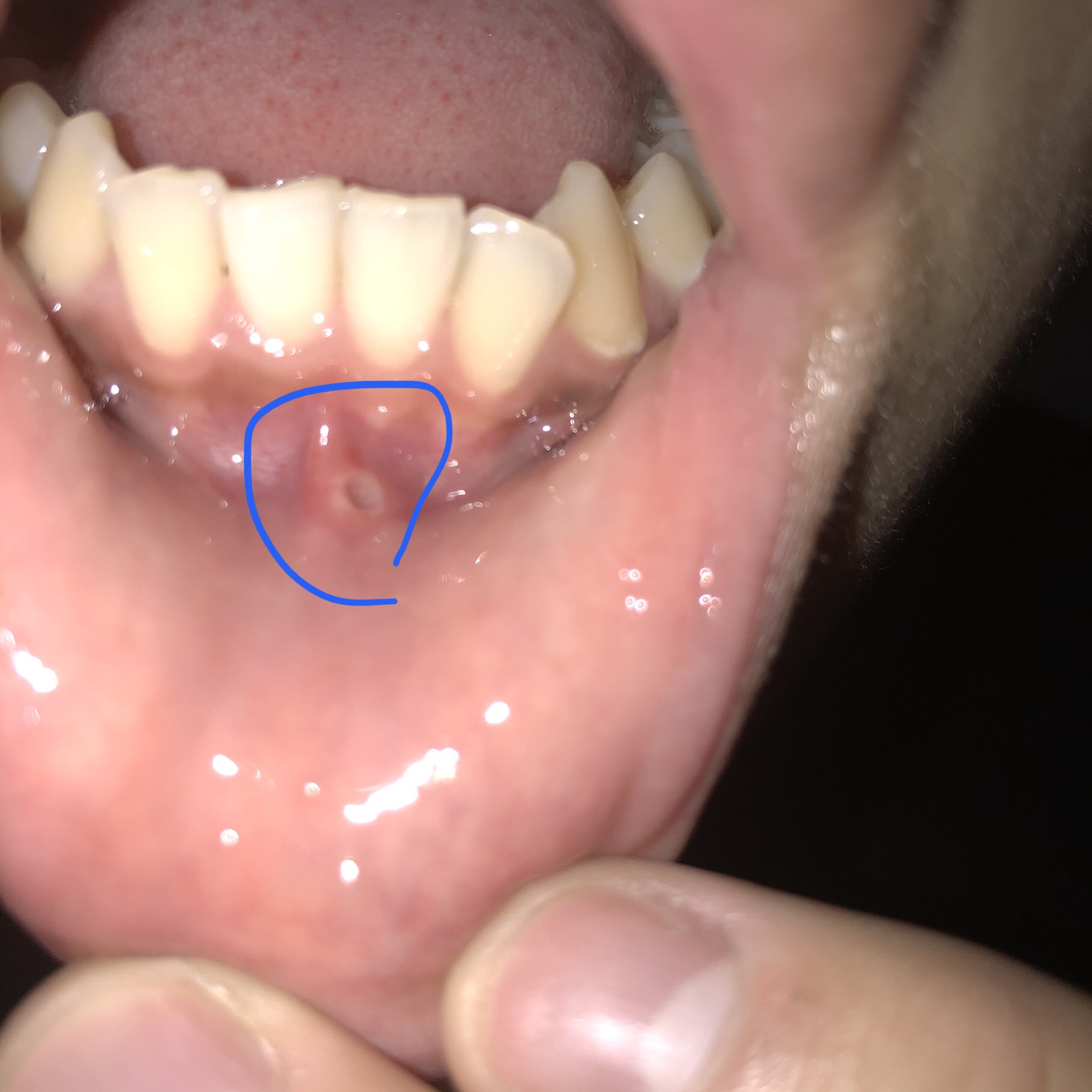 外傷性の口内炎について by こーしんしんさん の画像