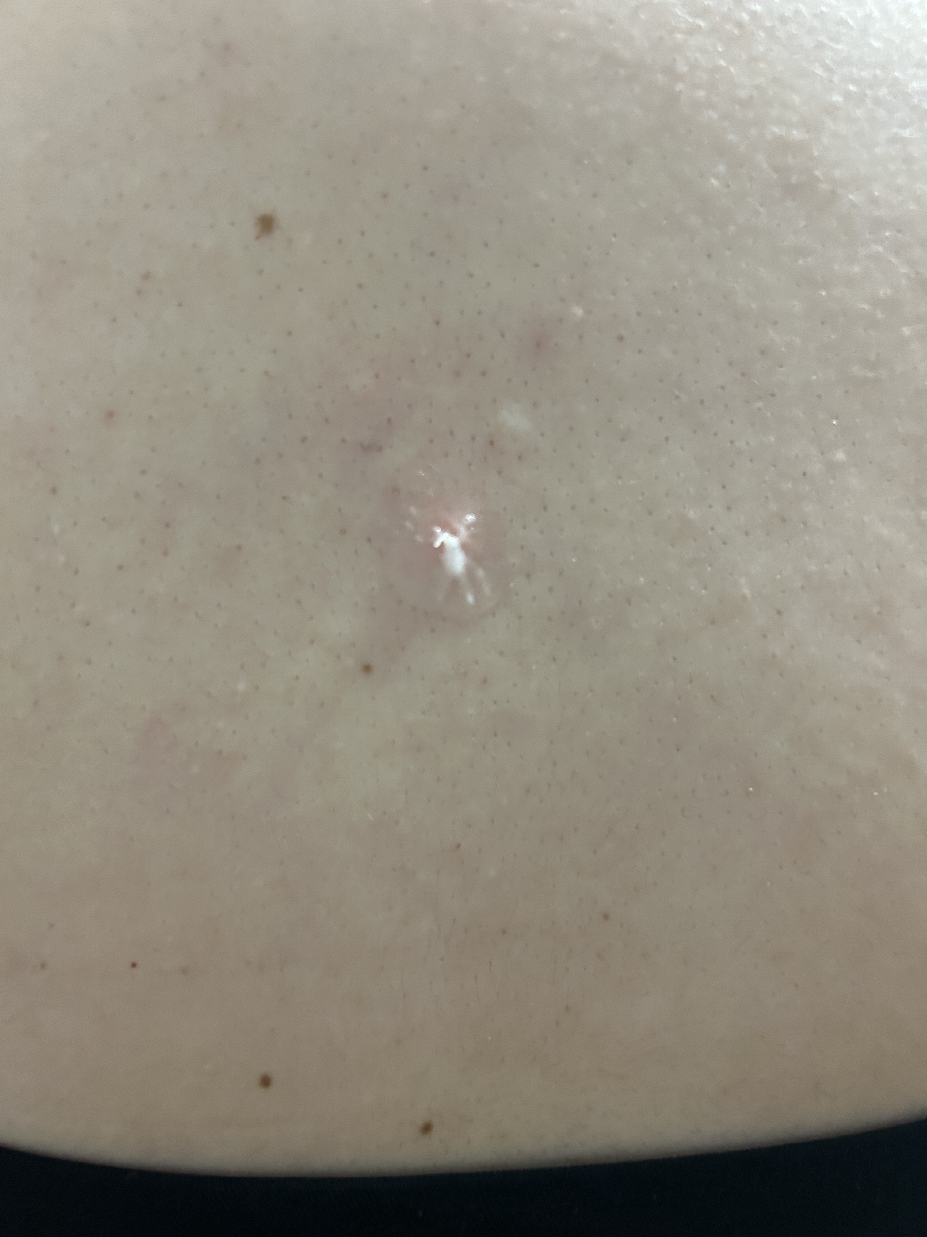 背中の毛穴ケアby 匿名さんの画像