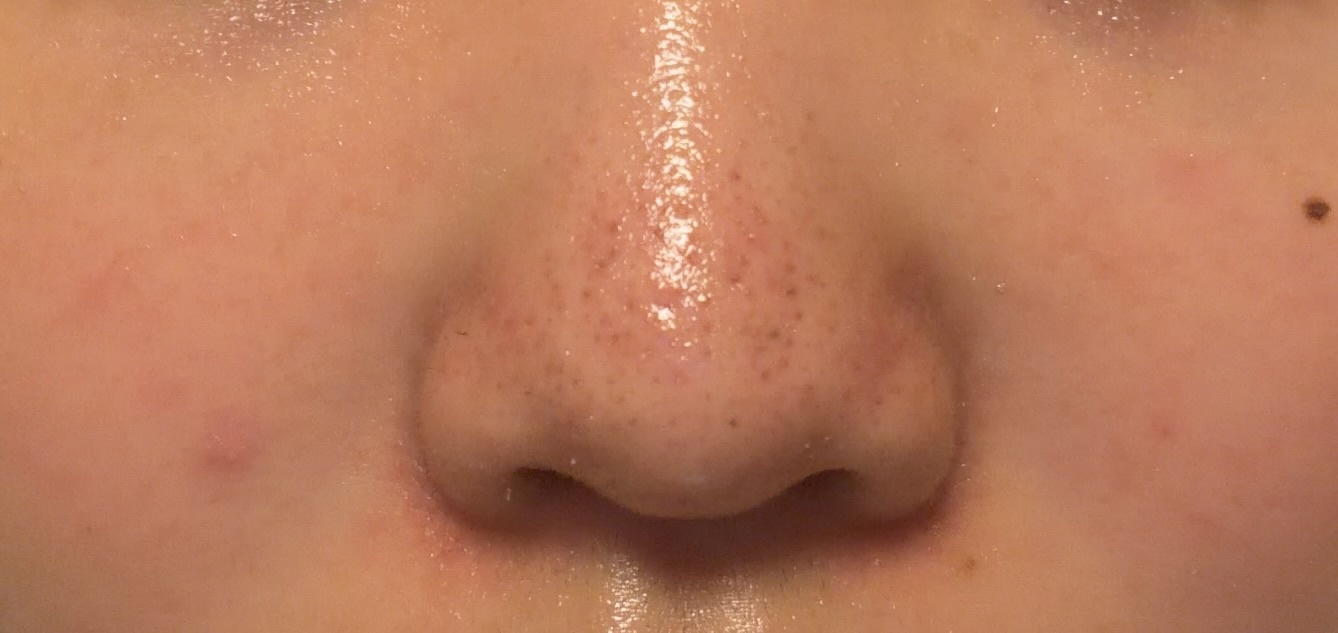 この肌の改善法教えてくださいт тby 匿名さんの画像