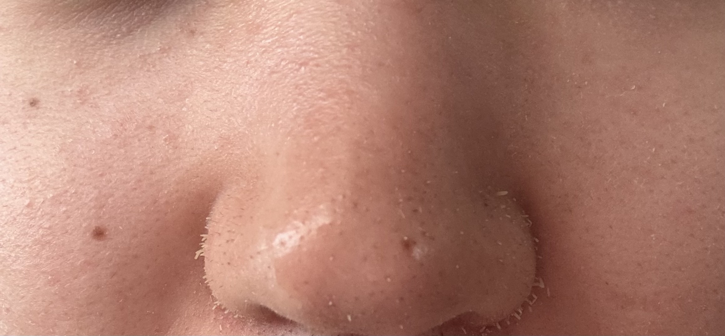 白角栓の治し方by ゆう9590さんの画像