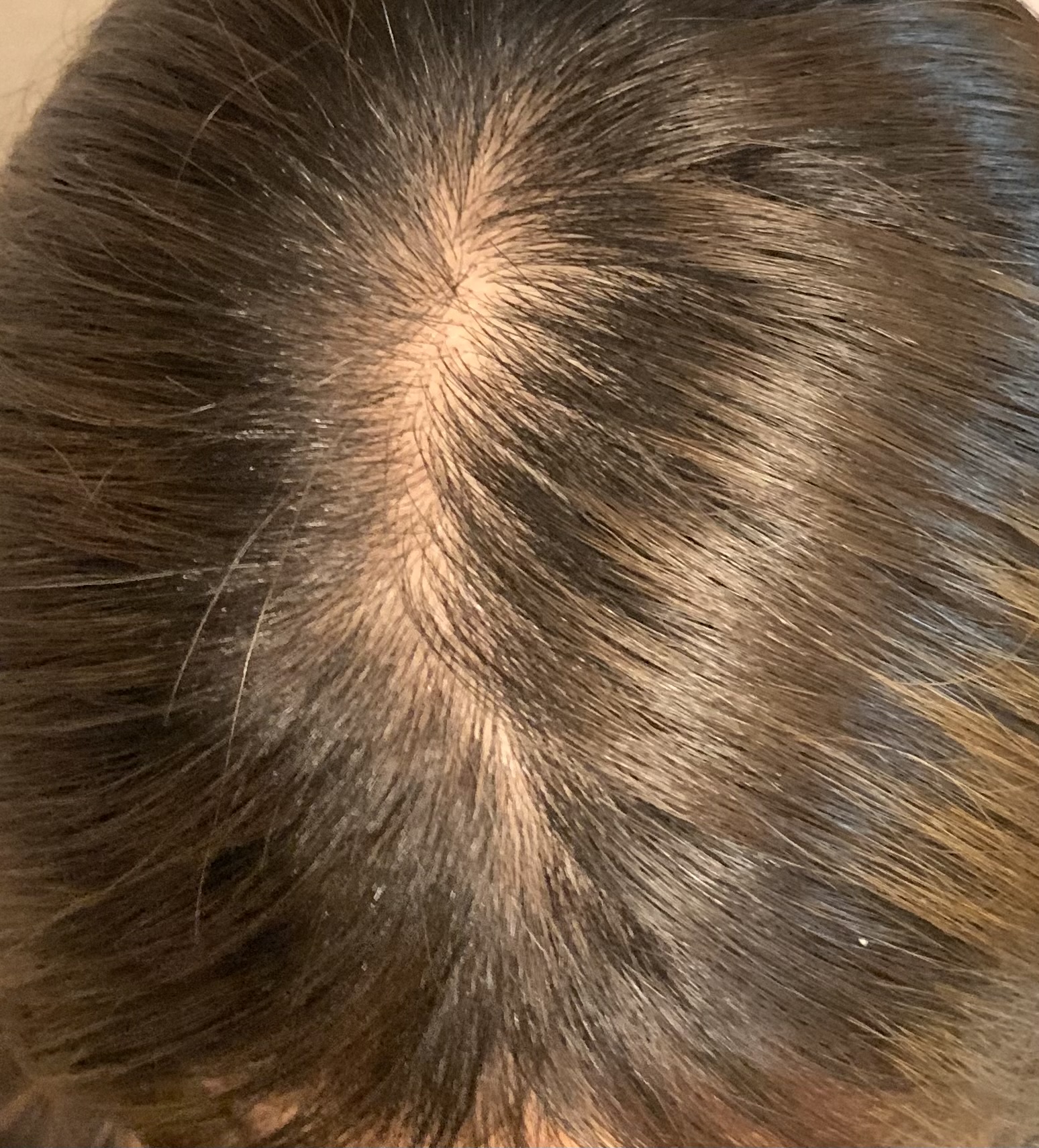 頭皮の毛が薄いby 匿名さんの画像