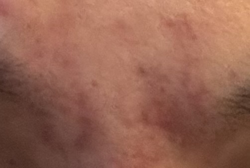 なに系のニキビ跡? by はれほさん の画像