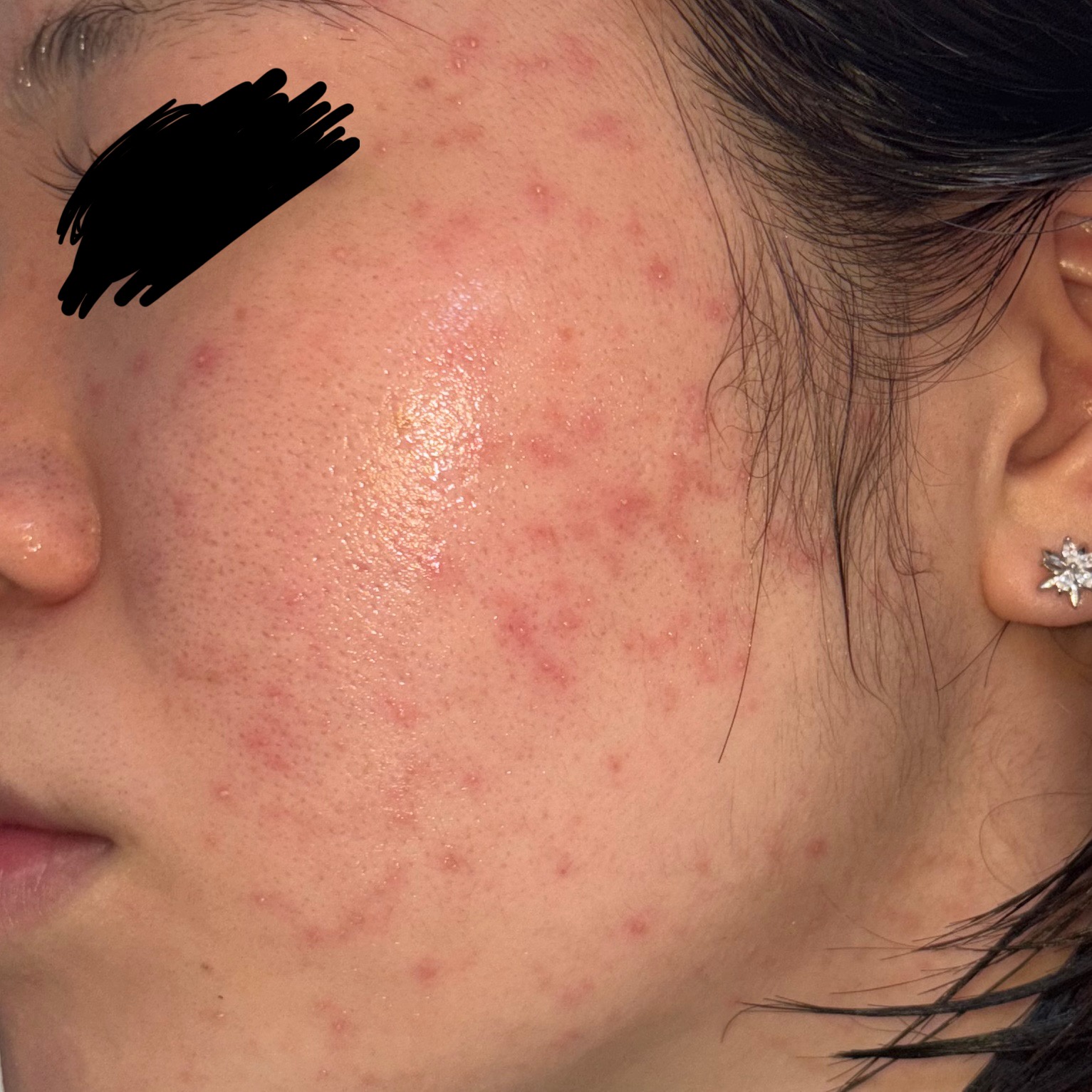 突然肌が大荒れしました。助けてください by 匿名さん の画像