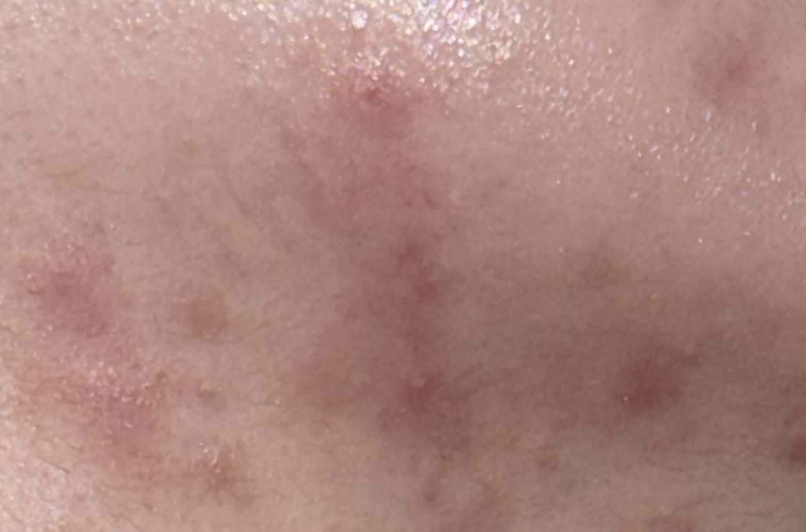 首のニキビ by あ4342さん の画像