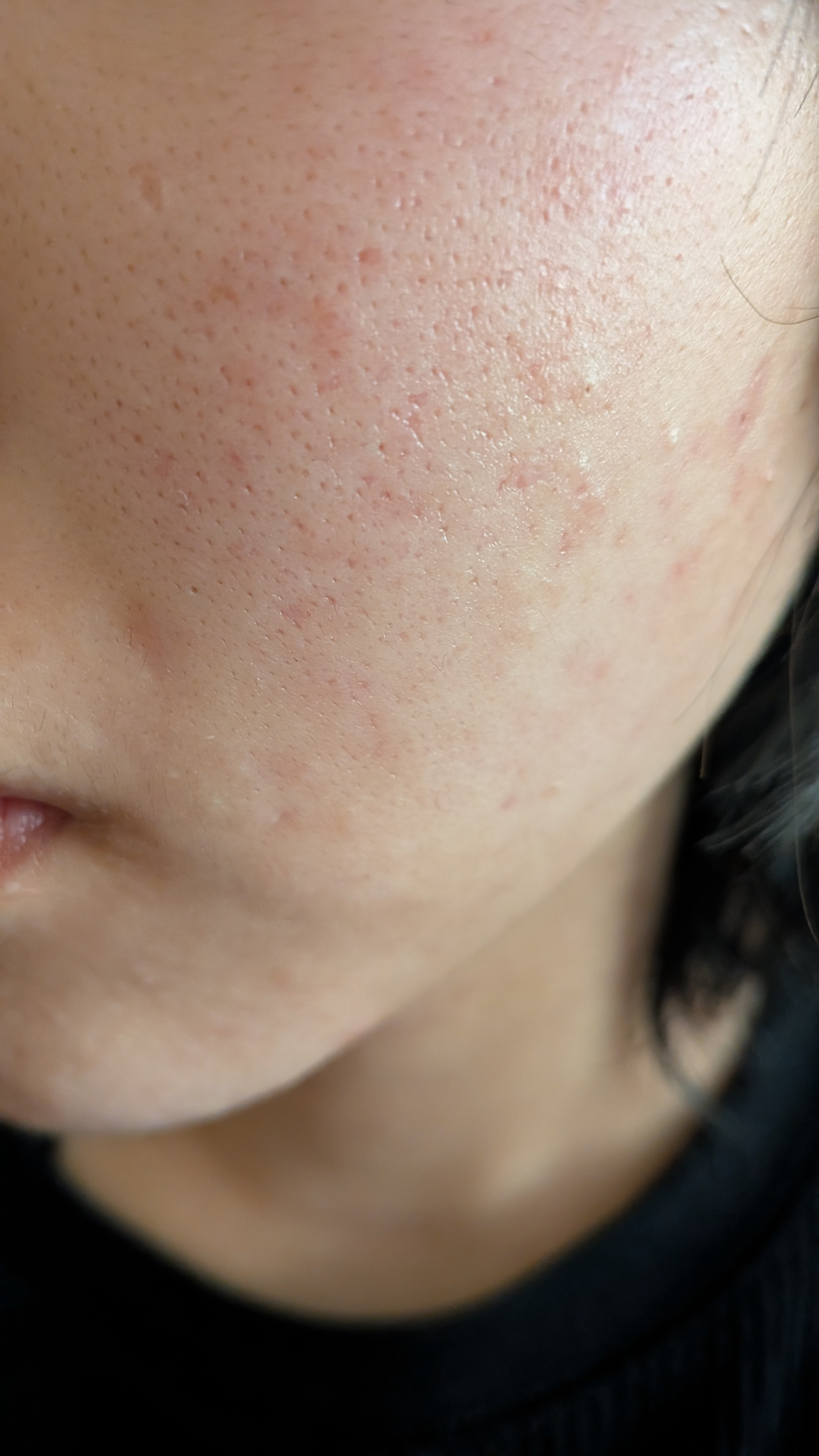 10代毛穴開きby ガト1116さんの画像