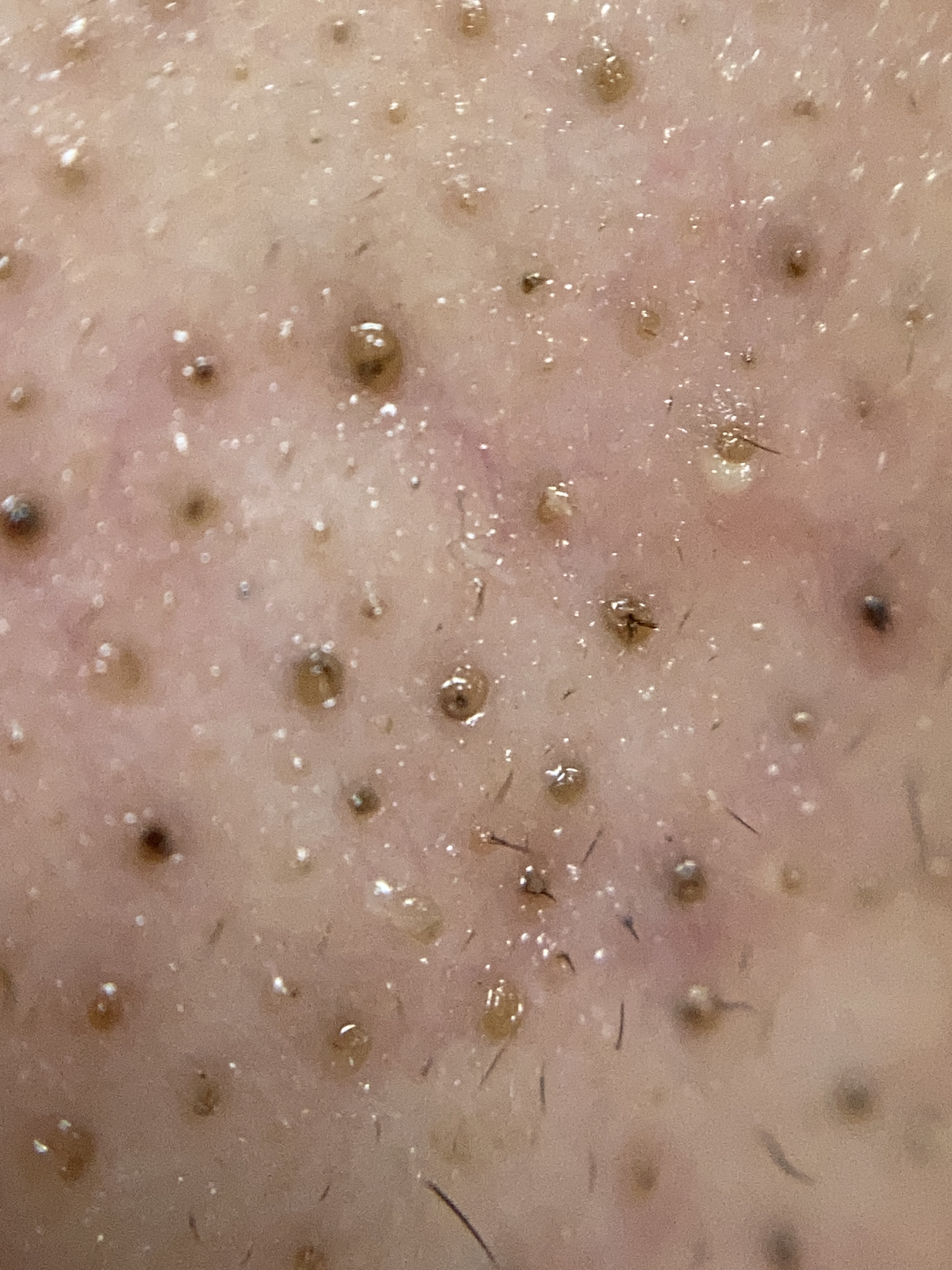 【画像閲覧注意】鼻の毛穴の黒ずみについてどう思いますか?by 脂性肌寄り混合肌の高校生男子さんの画像