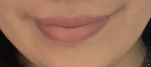 口元の左右差と顔の歪み by 匿名さん の画像