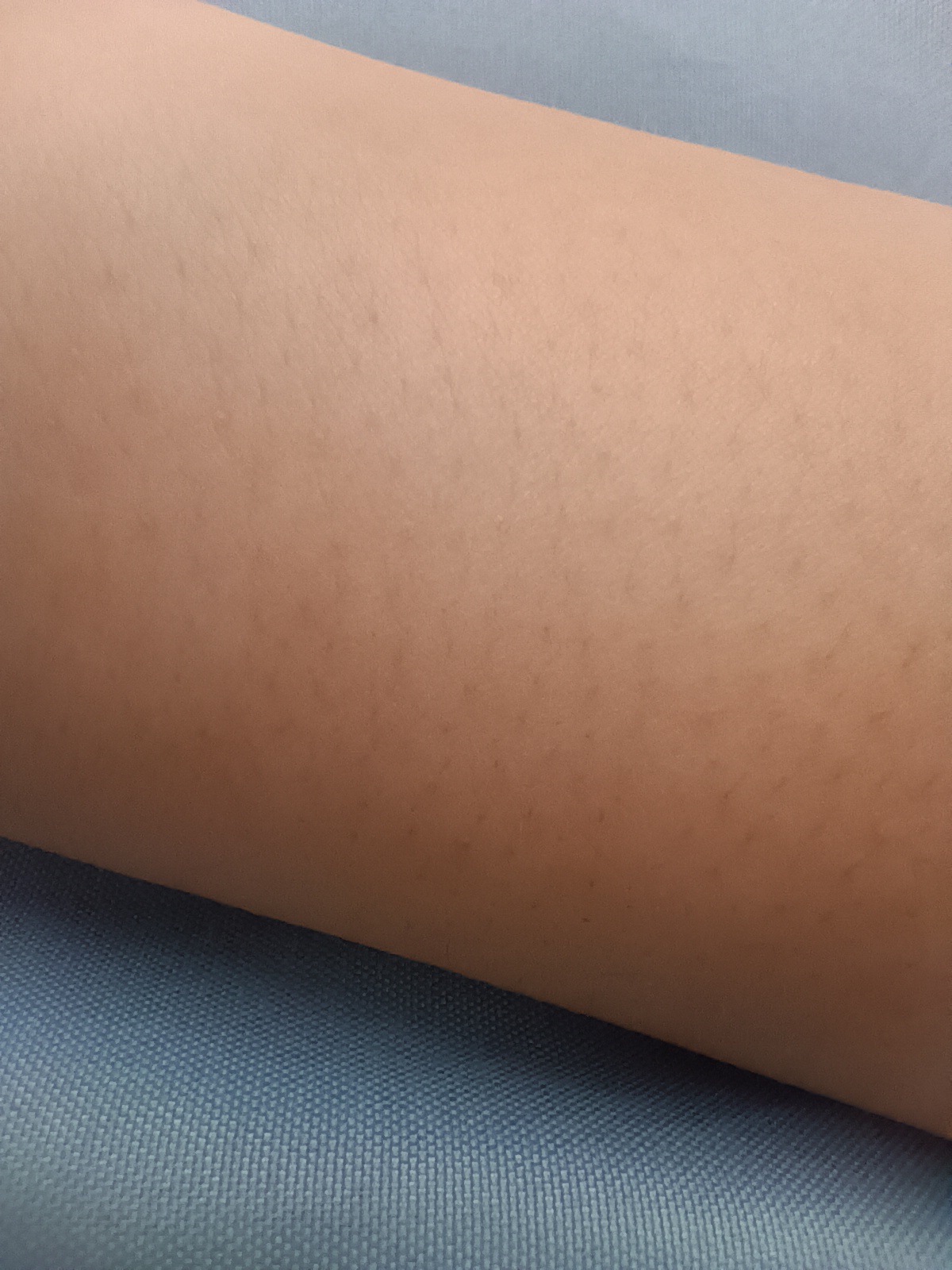 これって毛孔性苔癬なのでしょうか? by 鳥肌学生さん の画像