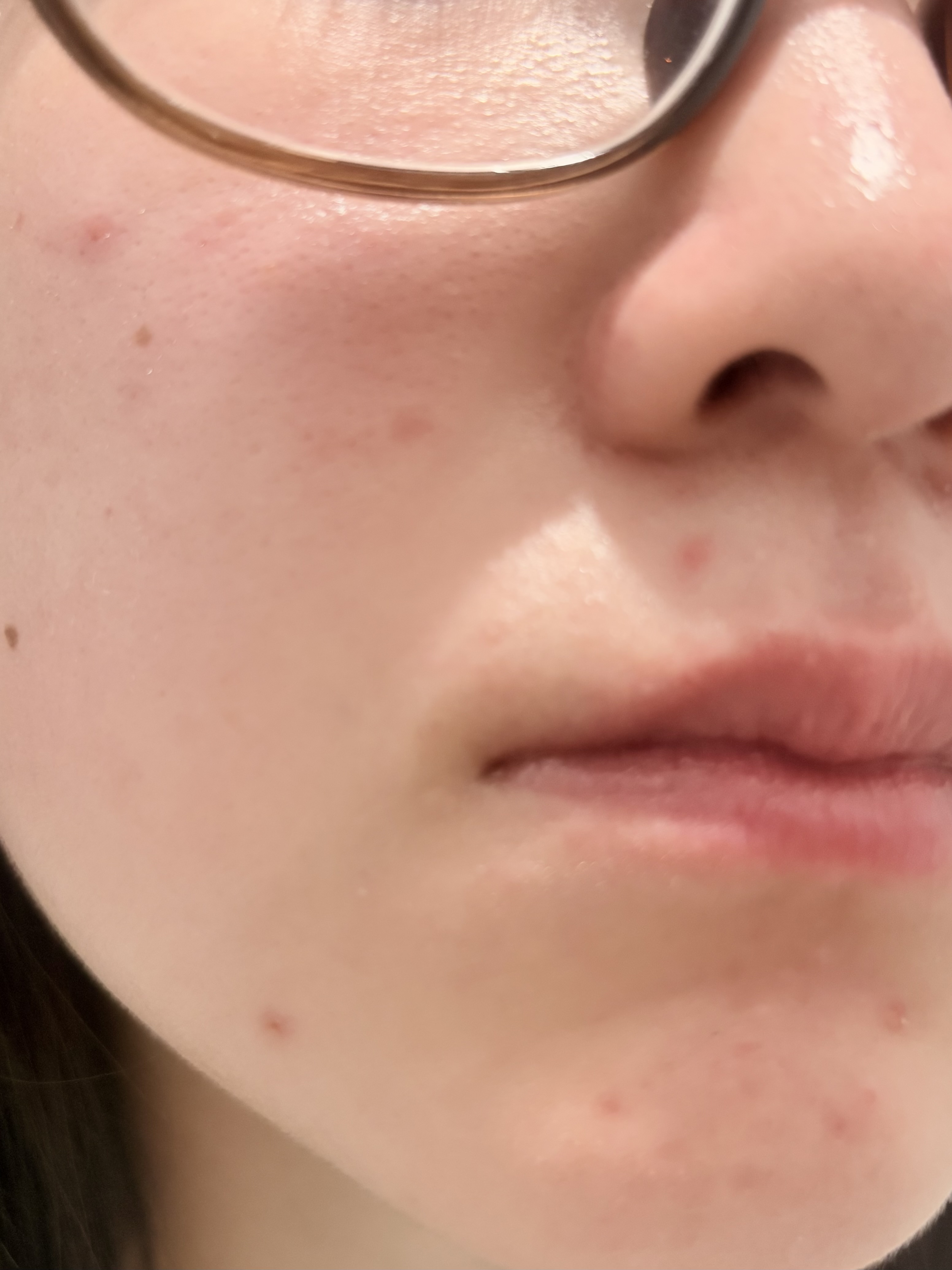 肌荒れ。。 by 匿名さん の画像