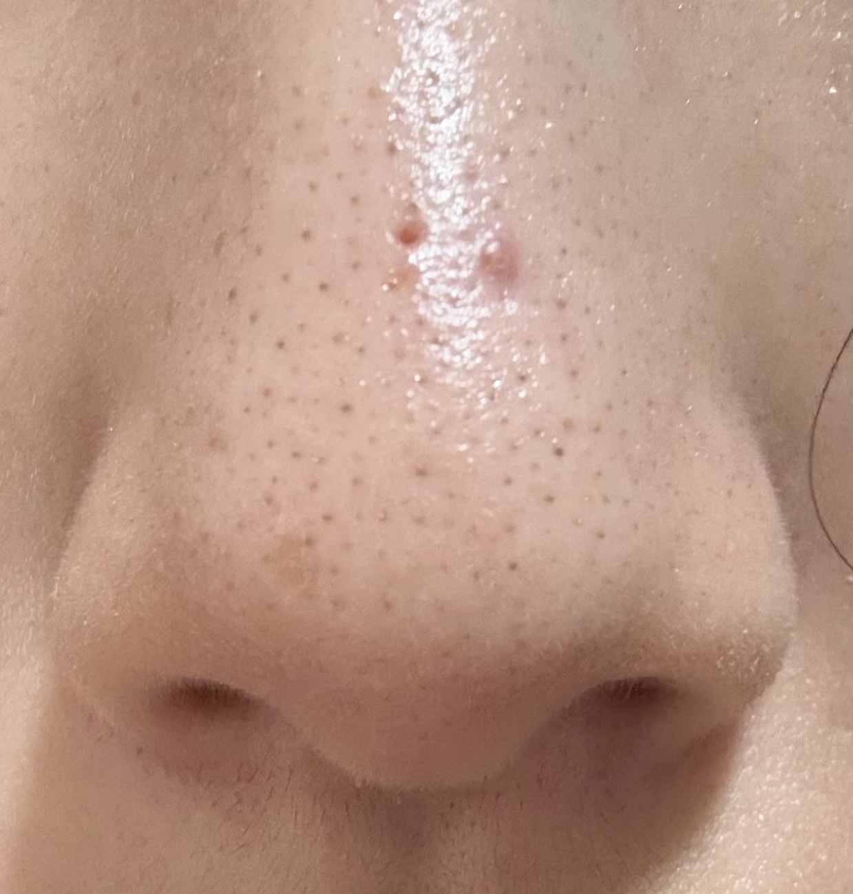 黒ずみ毛穴 by ふーりんりんりさん の画像