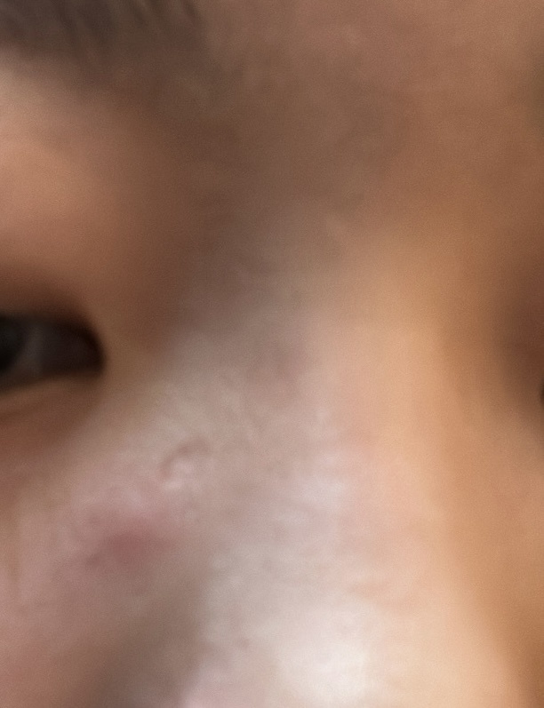 しこりニキビ by 匿名さん の画像