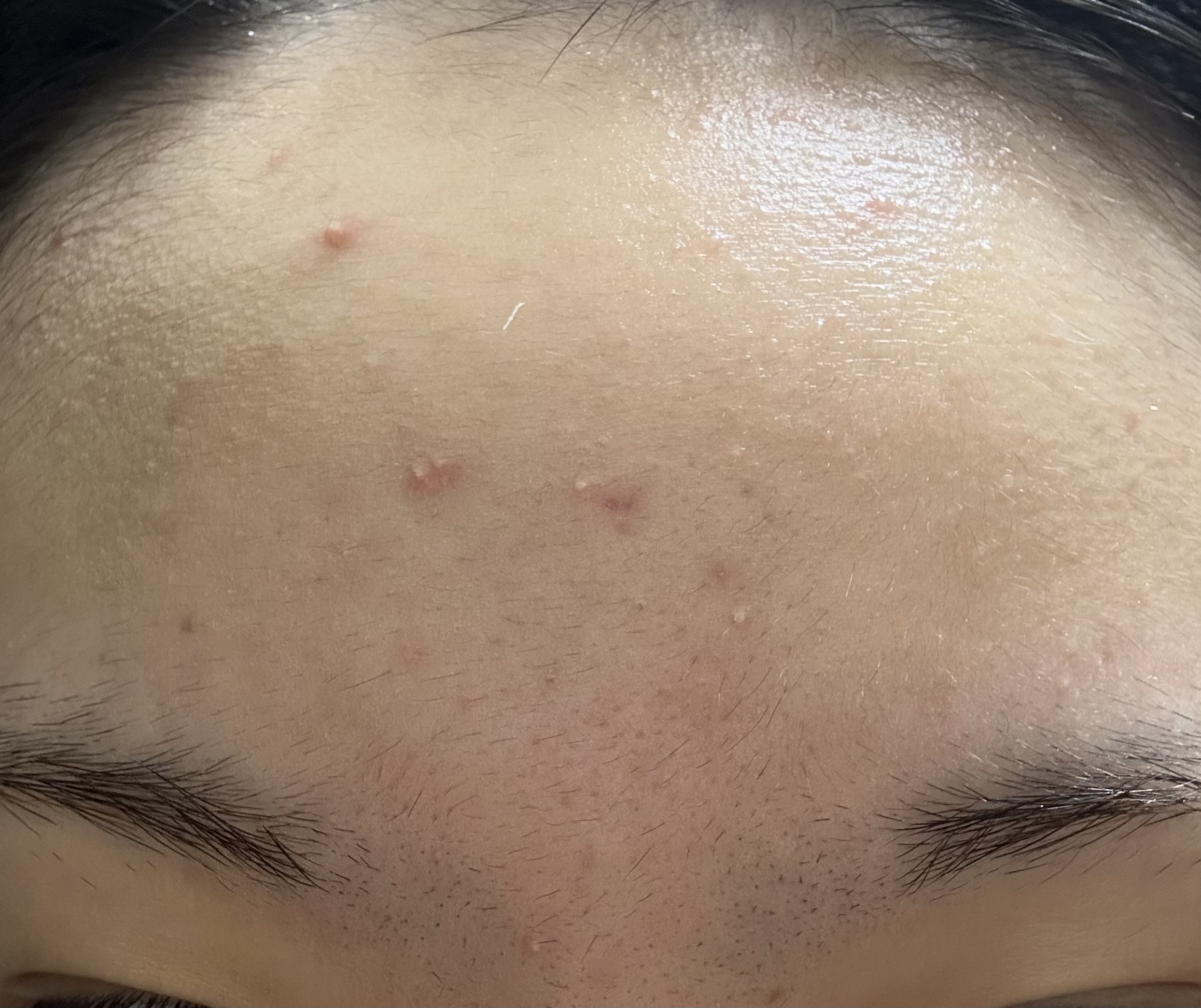 ニキビについて by せ!せ!り!さん の画像