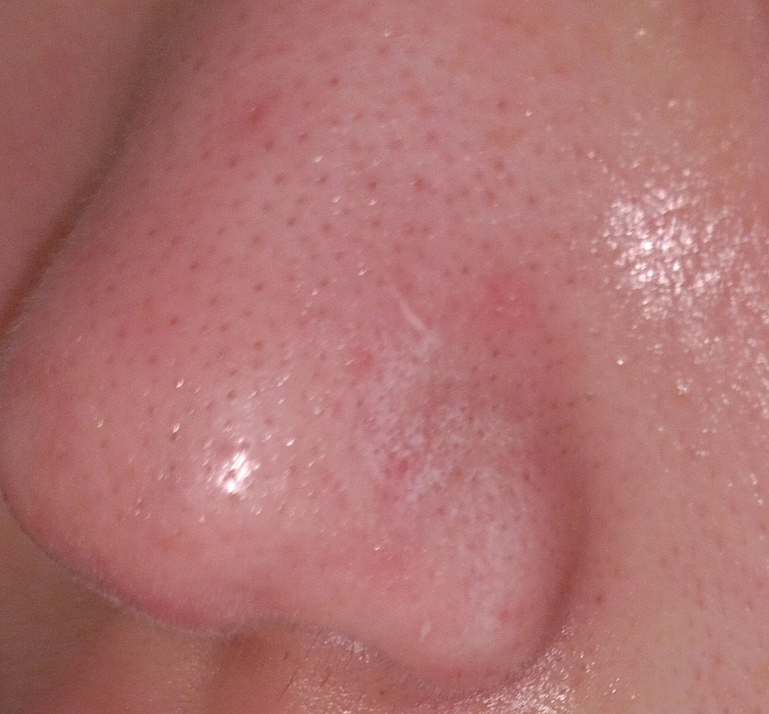 画像あり。毛穴 by り8752さん の画像