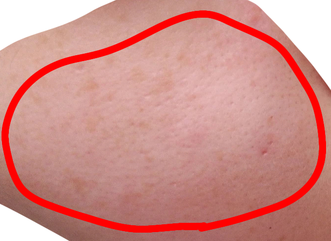 画像あり。頬の肌荒れ by り8752さん の画像