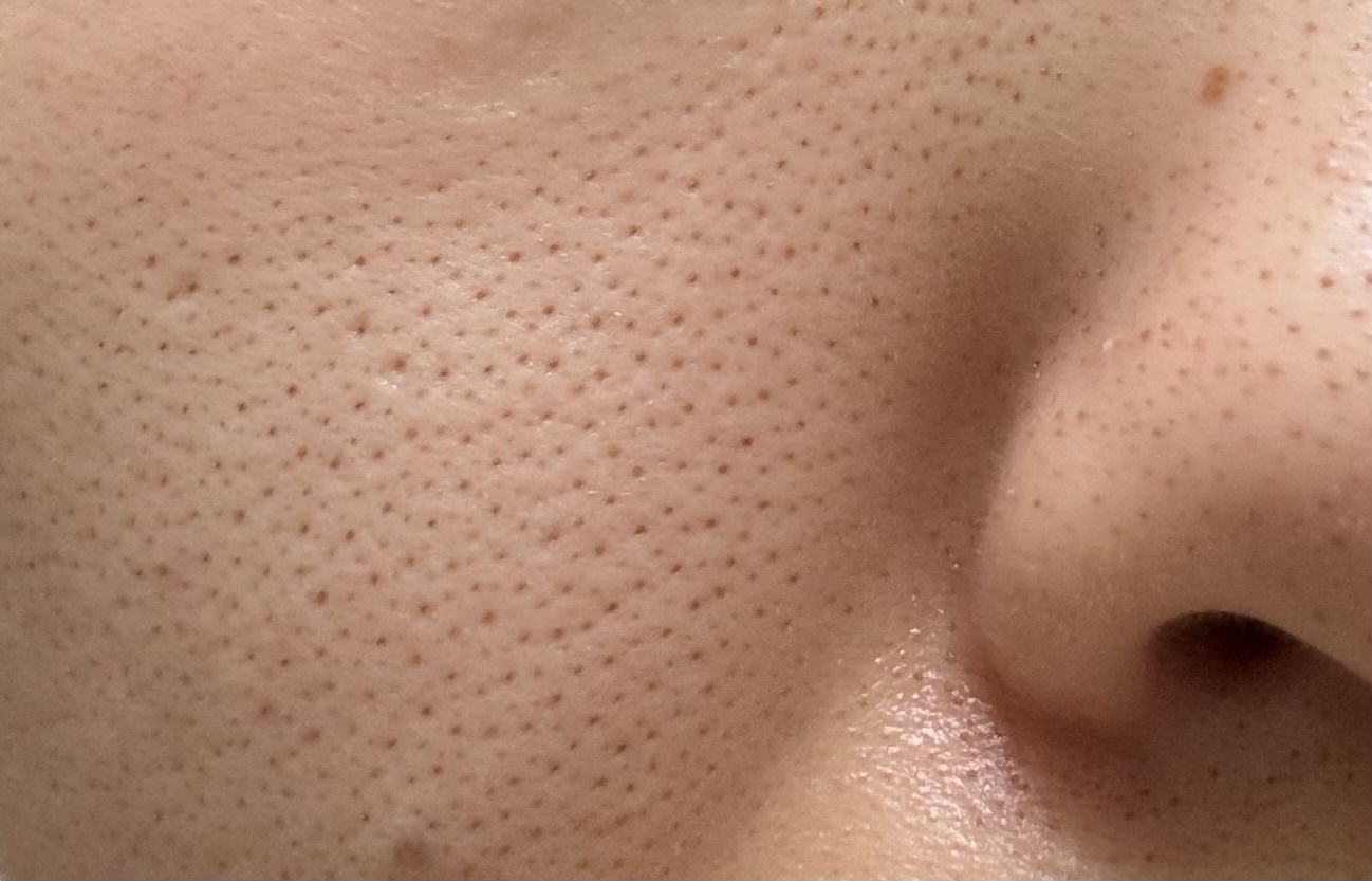 毛穴の種類について by 匿名さん の画像