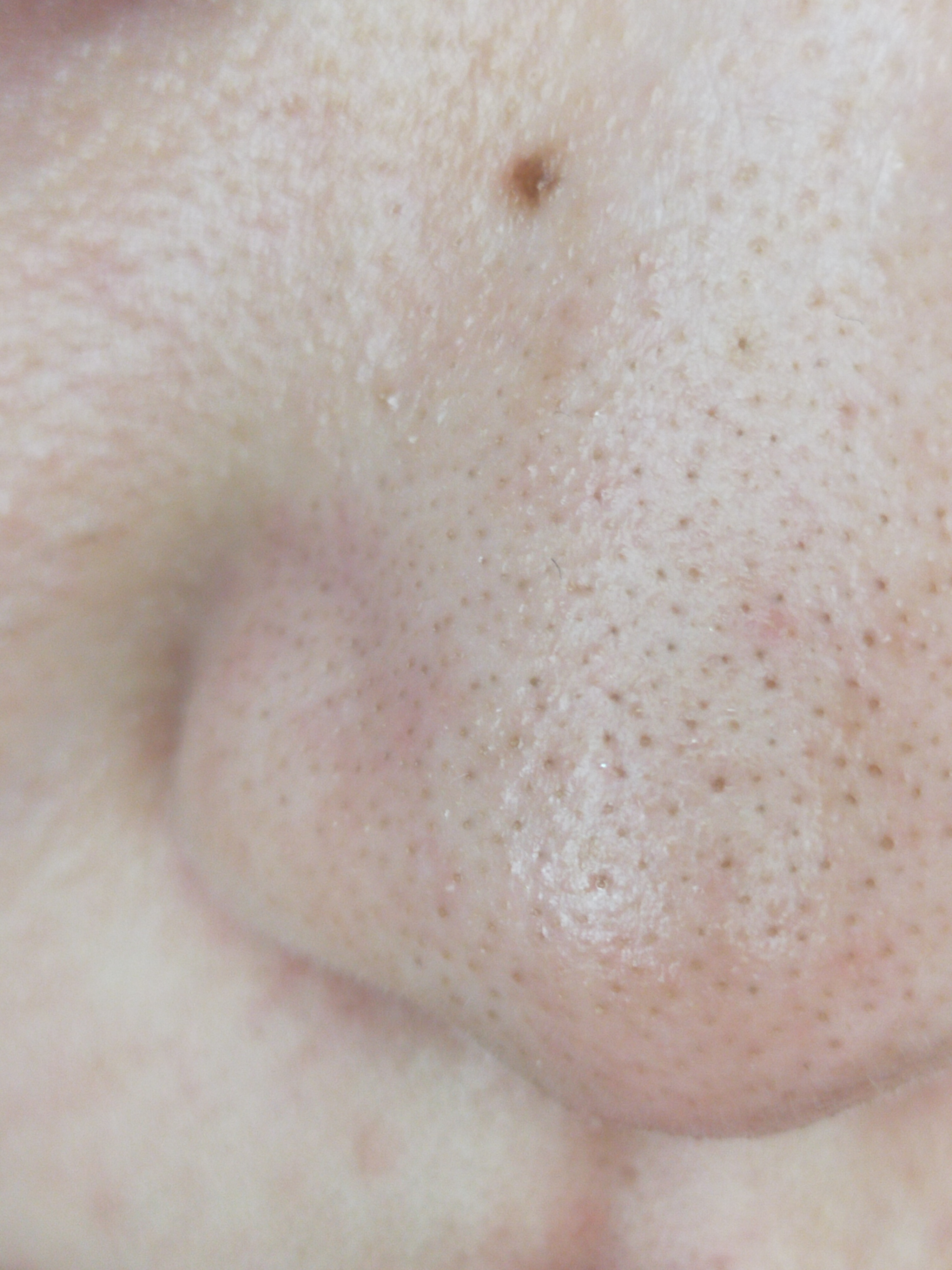 鼻の毛穴の種類 !!!閲覧注意!!! by あ9253さん の画像