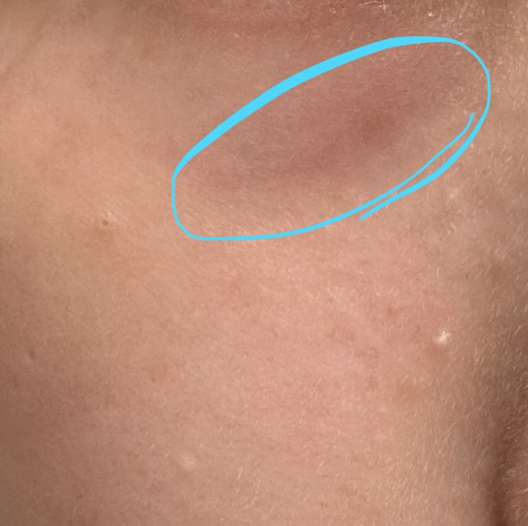 閲覧注意 クマ 目の下のたるみ悩みby 匿名さんの画像