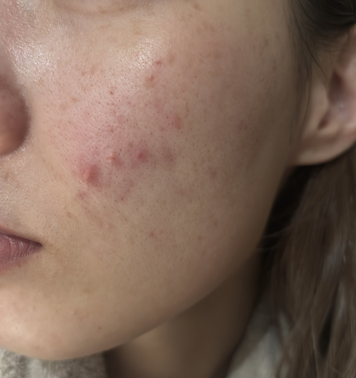 肌質改善 by もぐもぐ61さん の画像