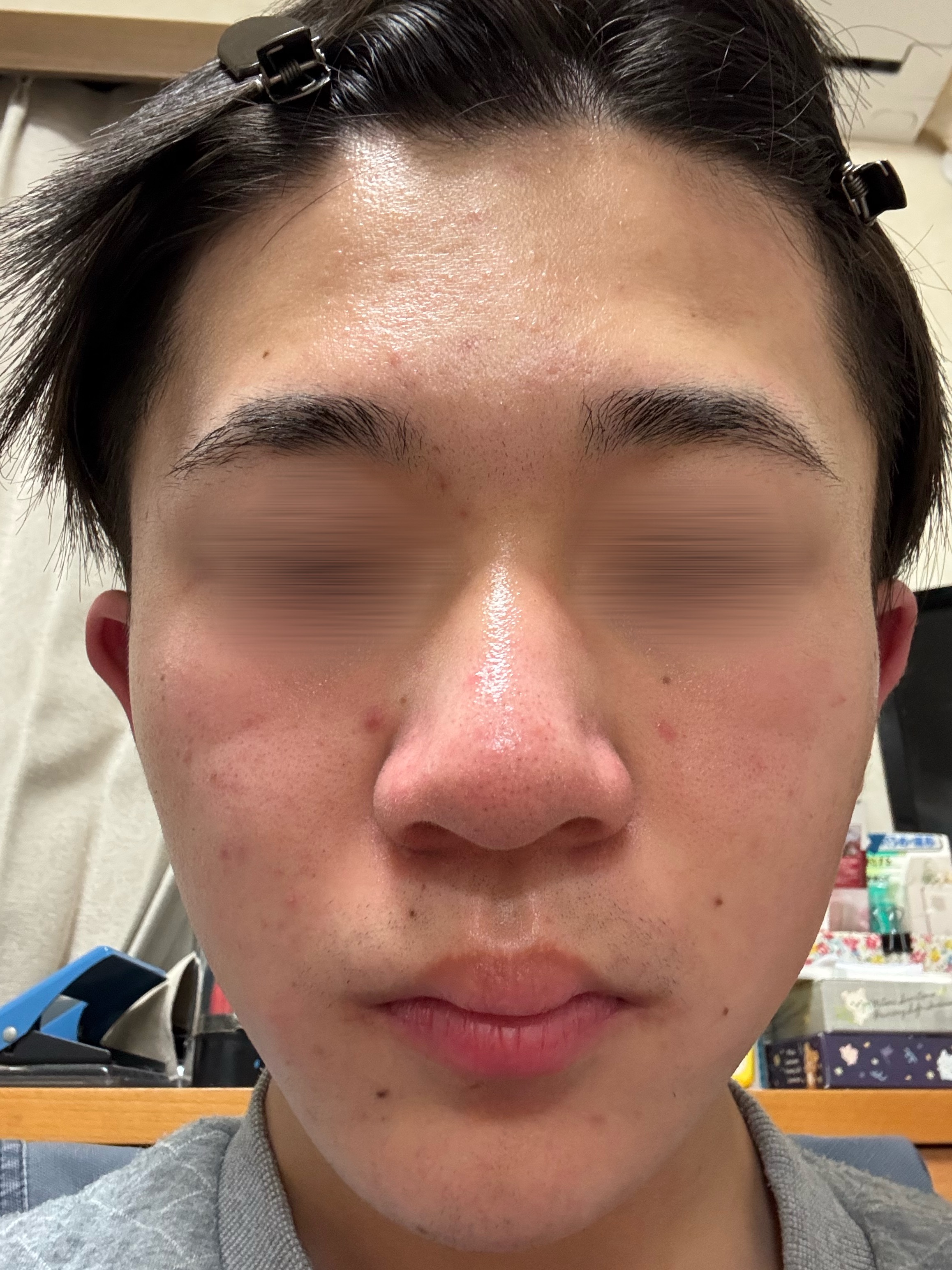 肌が良くならない…(顔画像注意) by ta5758さん の画像