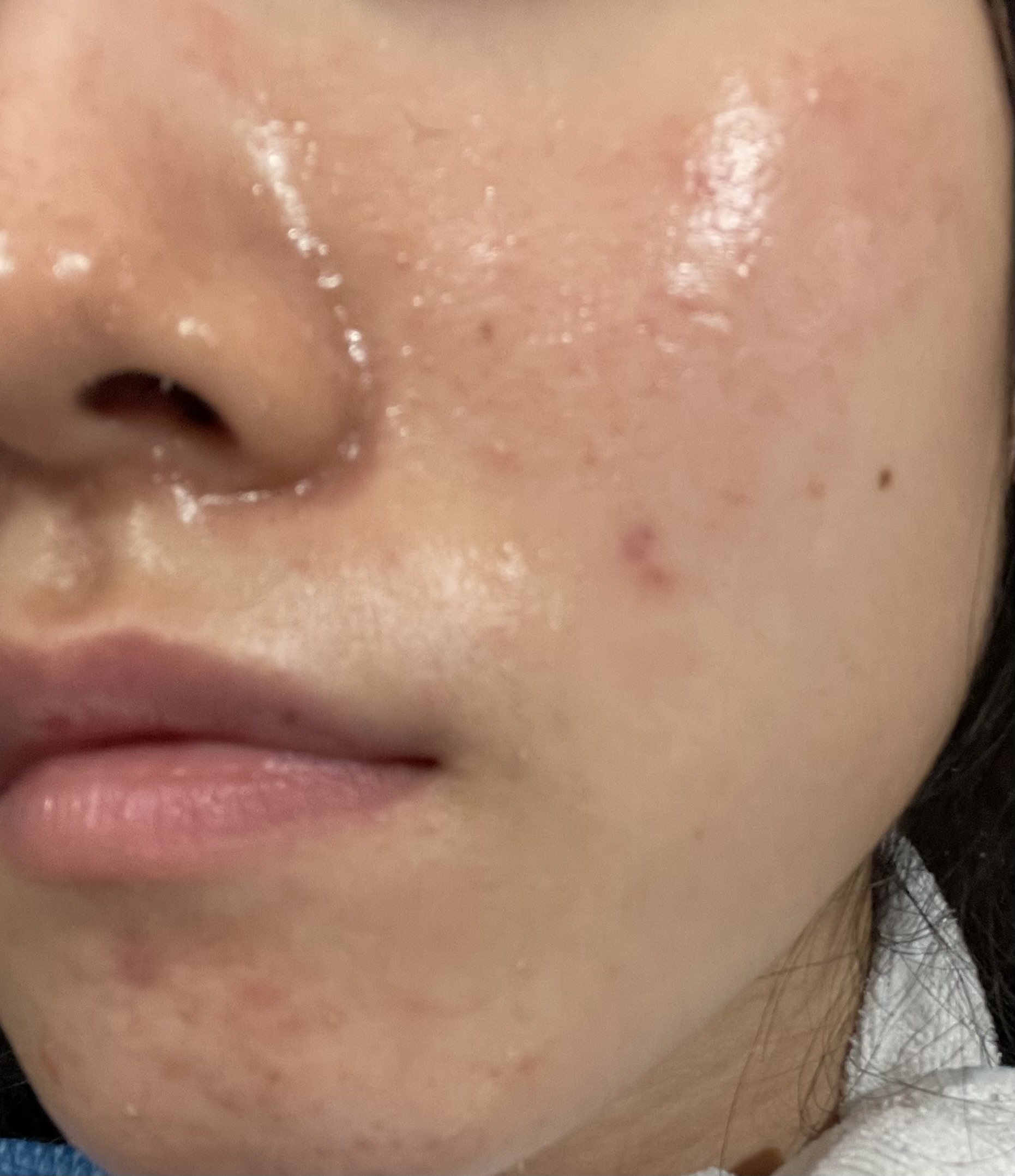 ニキビby ばっ2343さんの画像