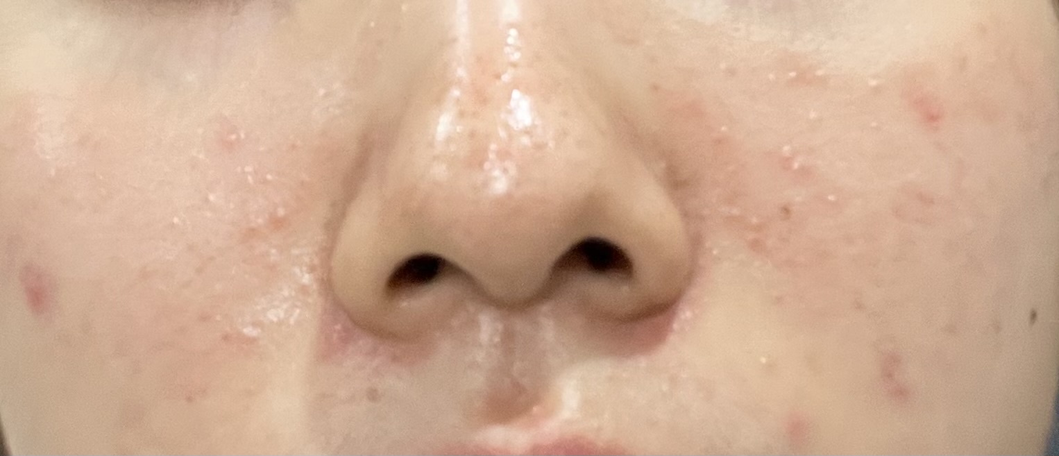 ニキビby ばっ2343さんの画像