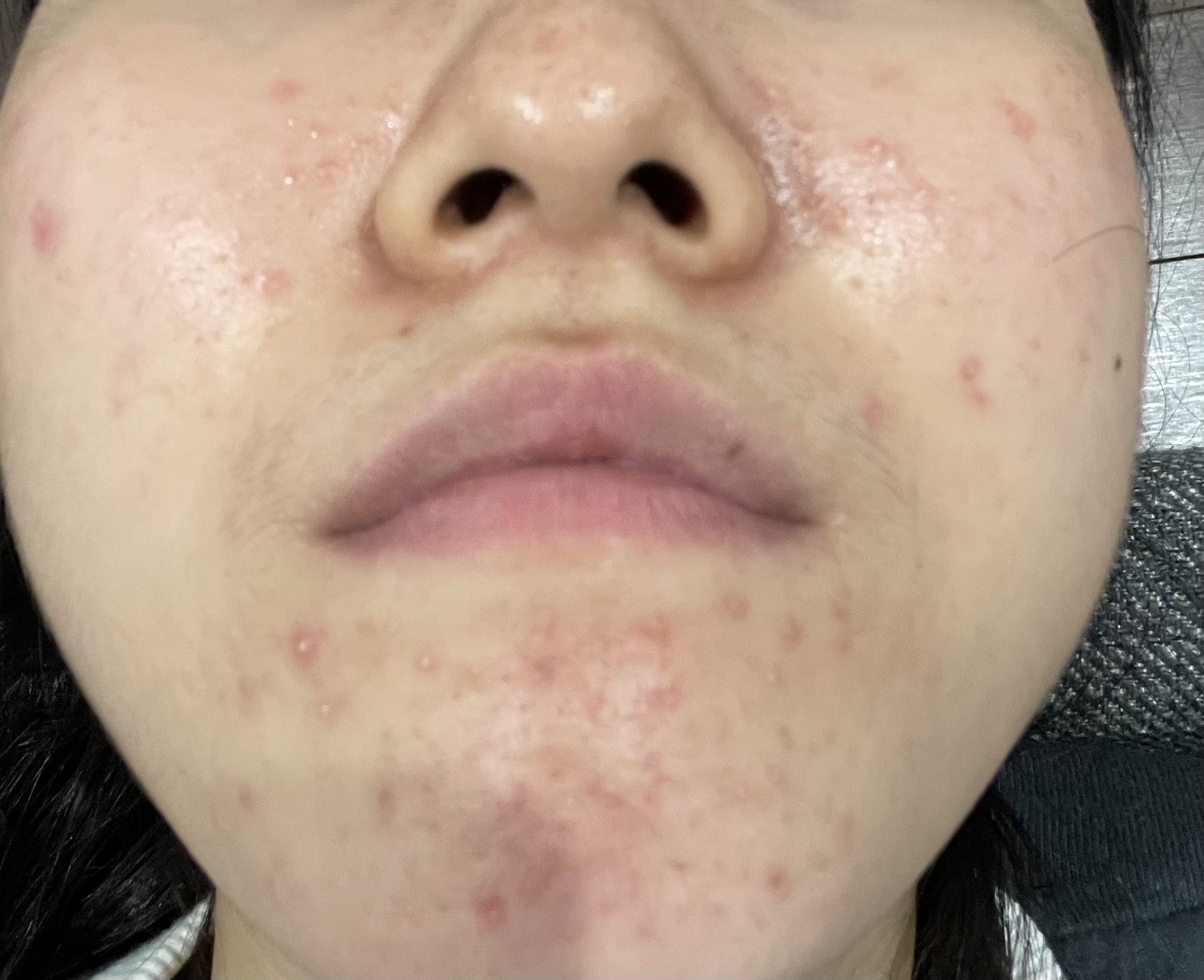 肌荒れby ばっ2343さんの画像