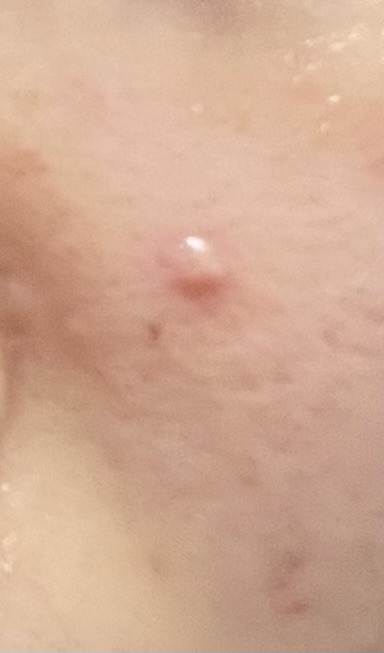 デカニキビby ばっ2343さんの画像