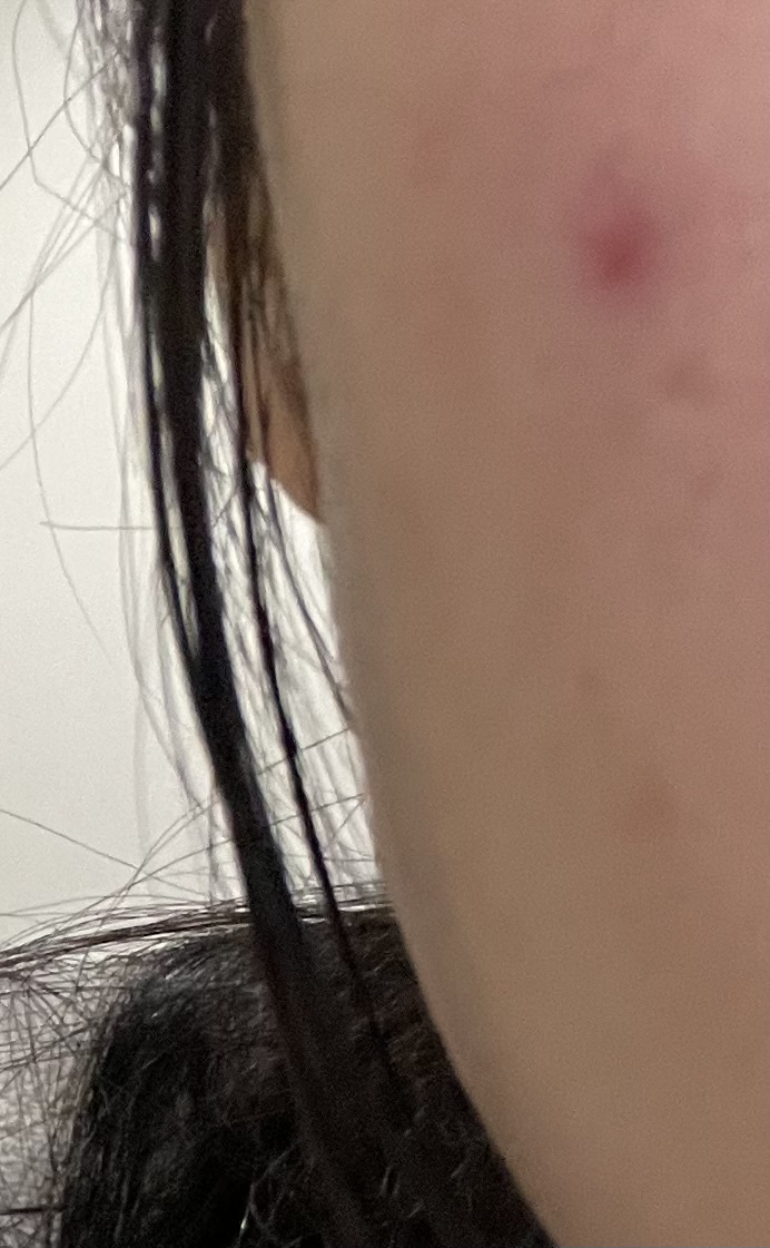 赤ニキビby ばっ2343さんの画像