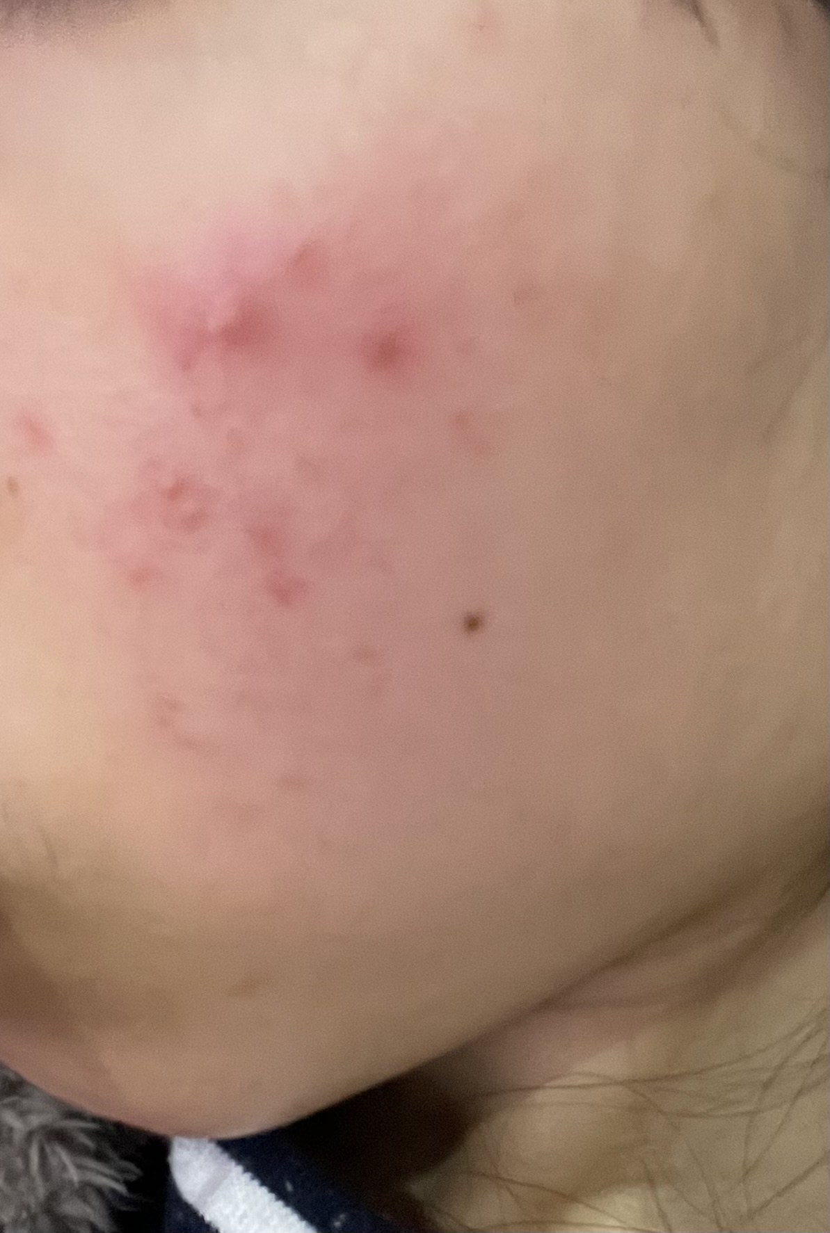 ニキビどうやって治した?by ばっ2343さんの画像