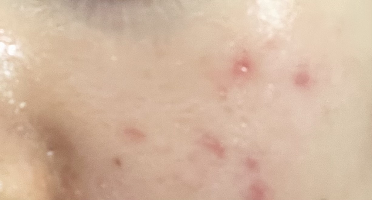 ニキビ跡?by ばっ2343さんの画像