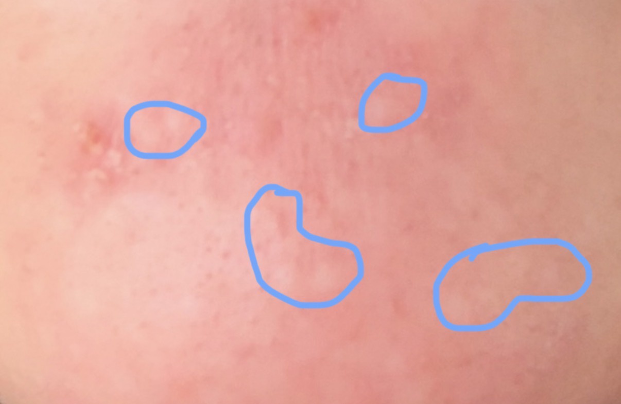 閲覧注意です!!これってニキビ跡ですか?? by 匿名さん の画像