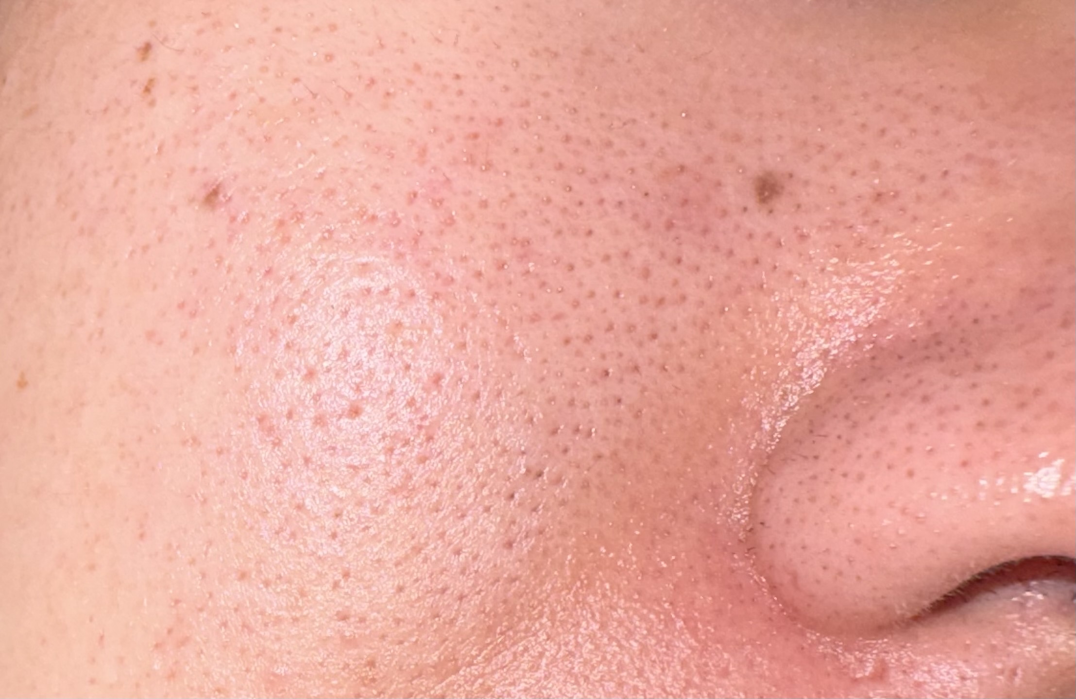 閲覧注意 毛穴のバケモノby モモンガ3089さんの画像