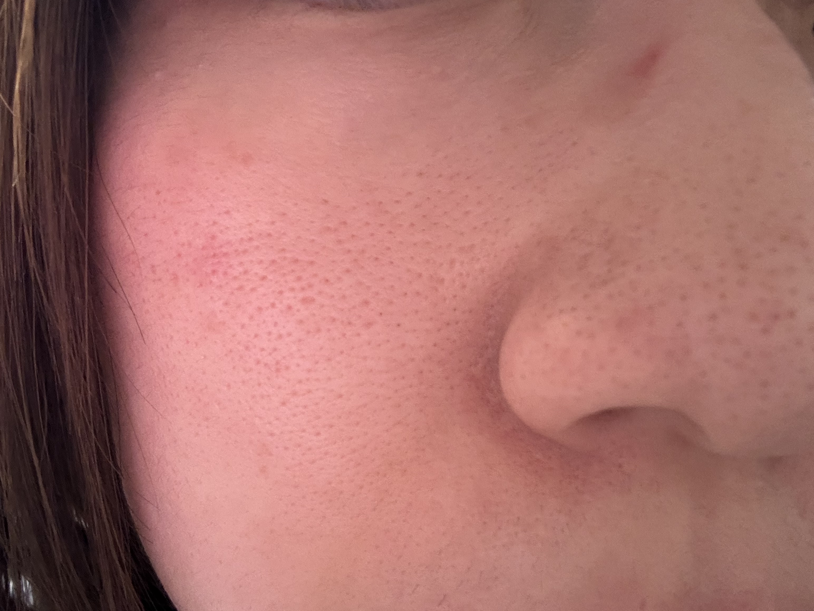 毛穴の悩みby アニオタさんさんの画像