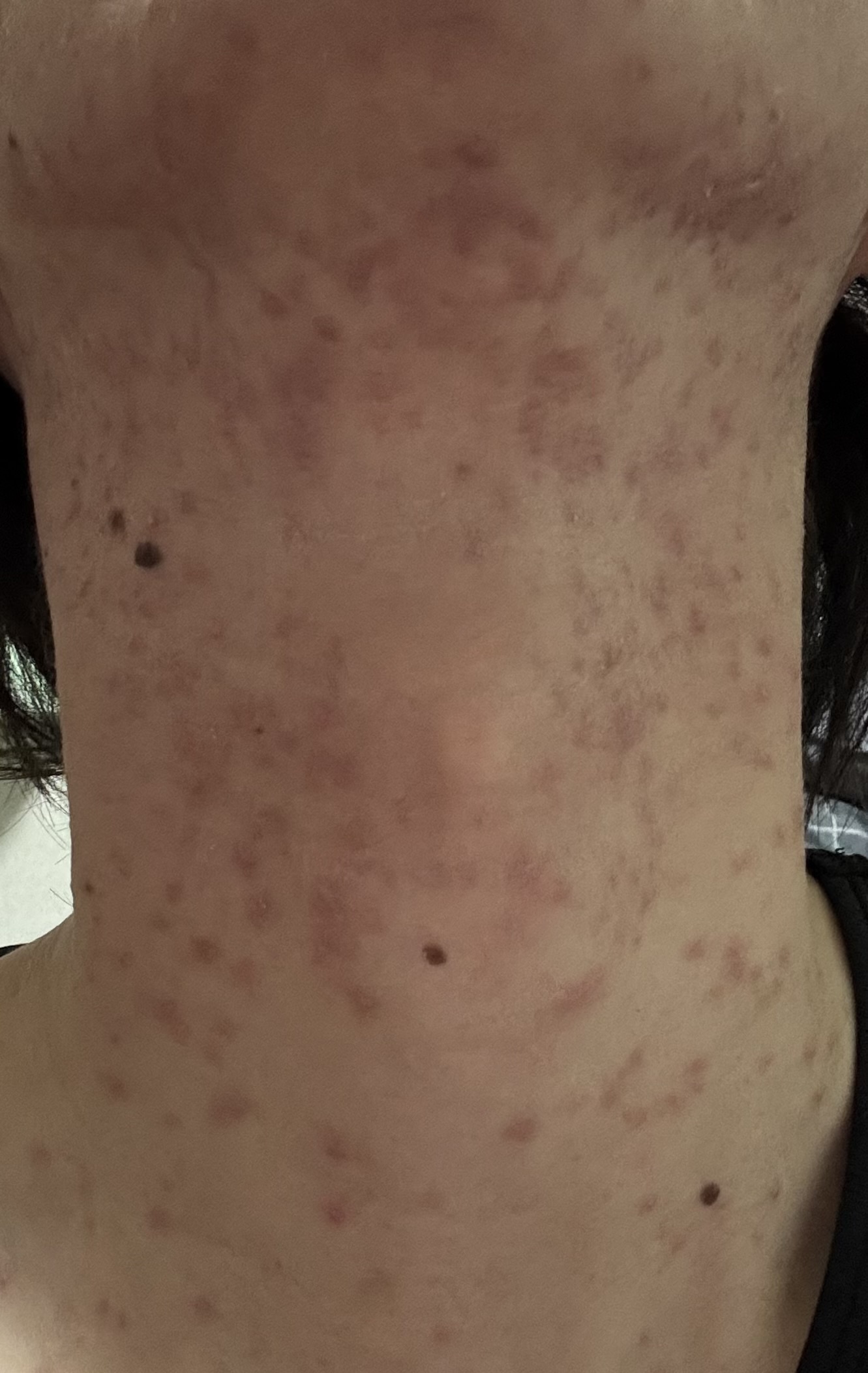 首の肌荒れについて by ノ0221さん の画像