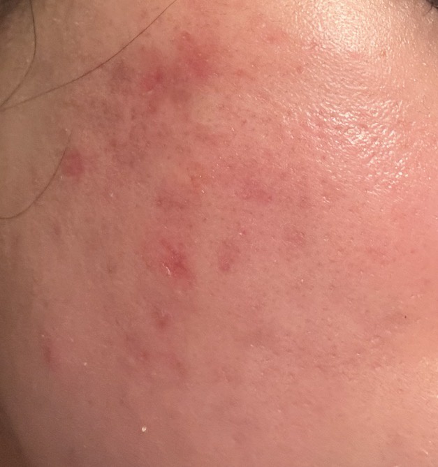 ニキビ跡 by 真理1159さん の画像