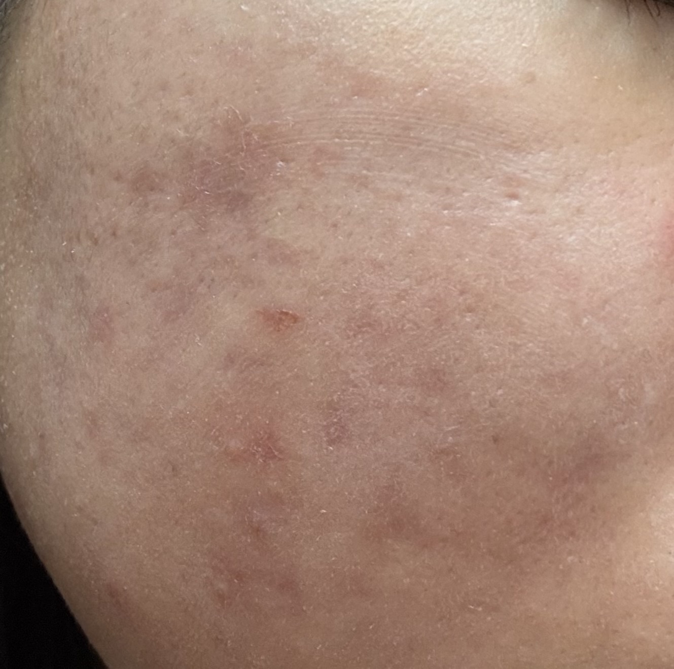 ニキビ跡 by 真理1159さん の画像