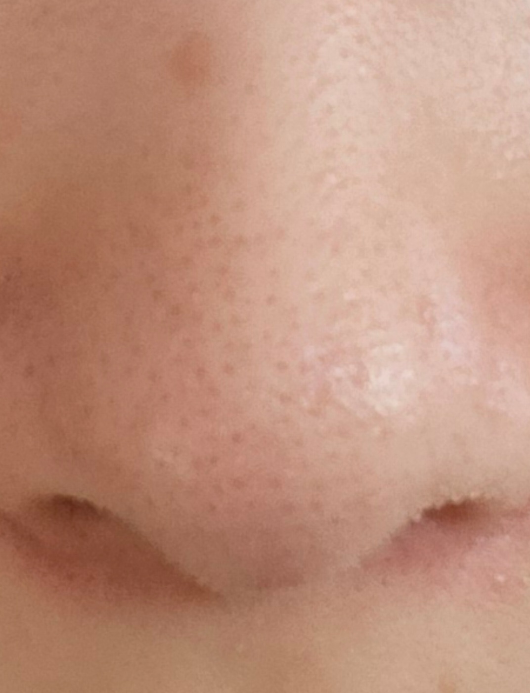 鼻の黒ずみby 匿名さんの画像