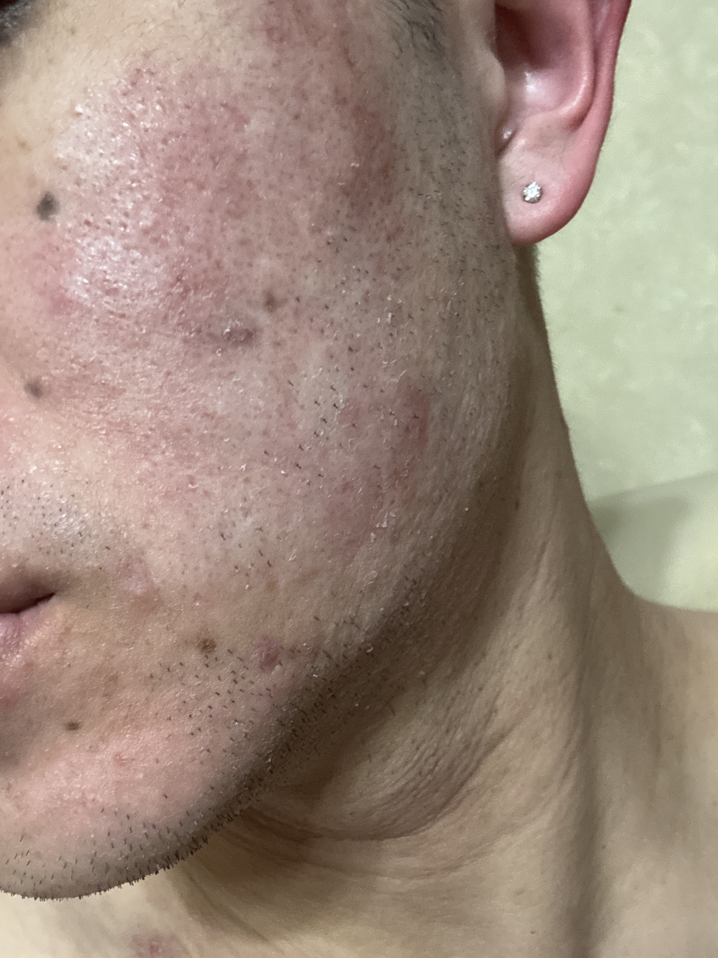 脂漏性皮膚炎ですか?by にゃす3090さんの画像