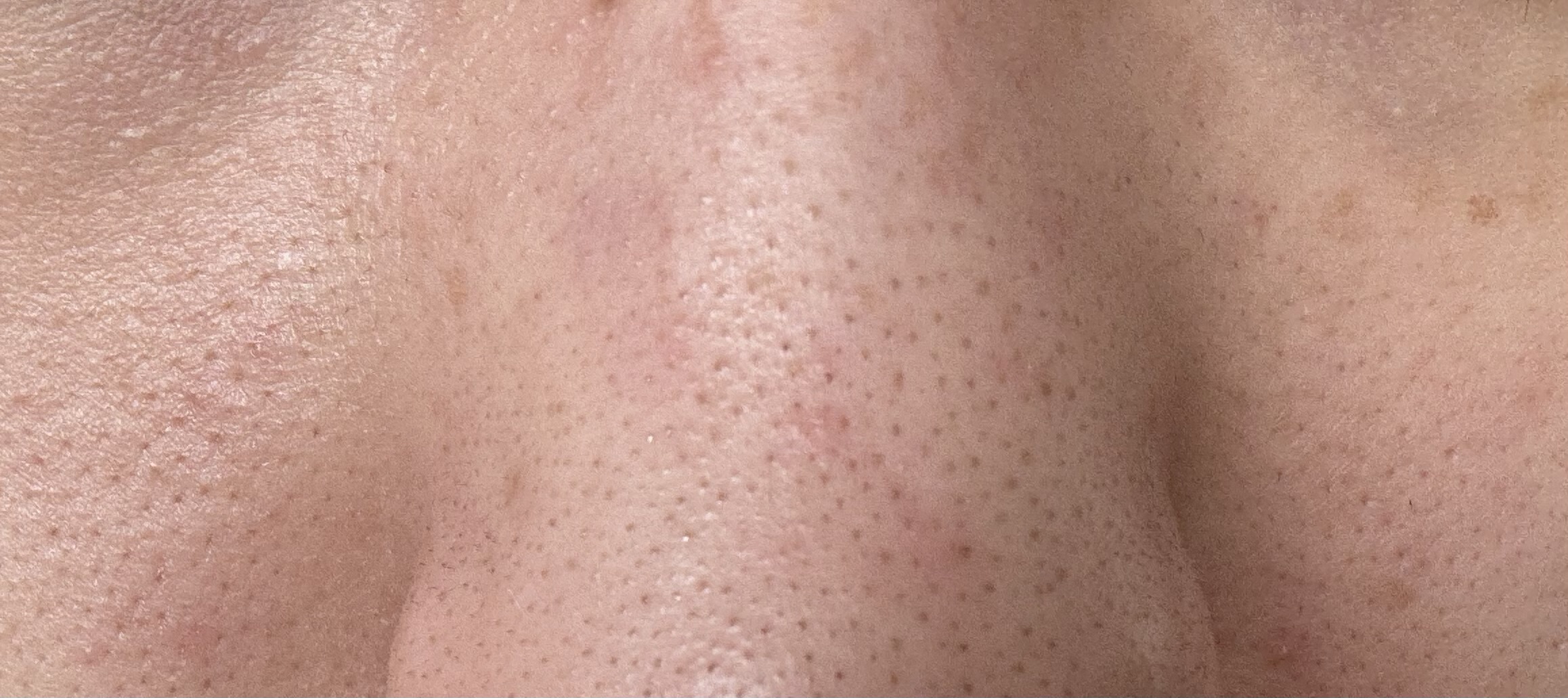 毛穴の悩みby Greenpepperさんの画像