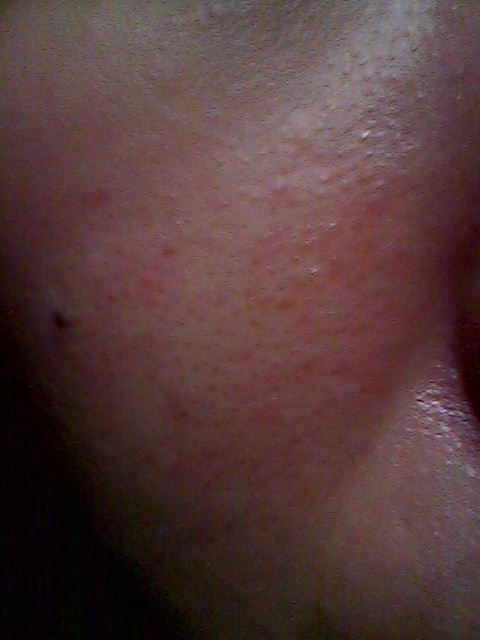 毛穴とぷつぷつ by **にゃむにゃむ**さん の画像