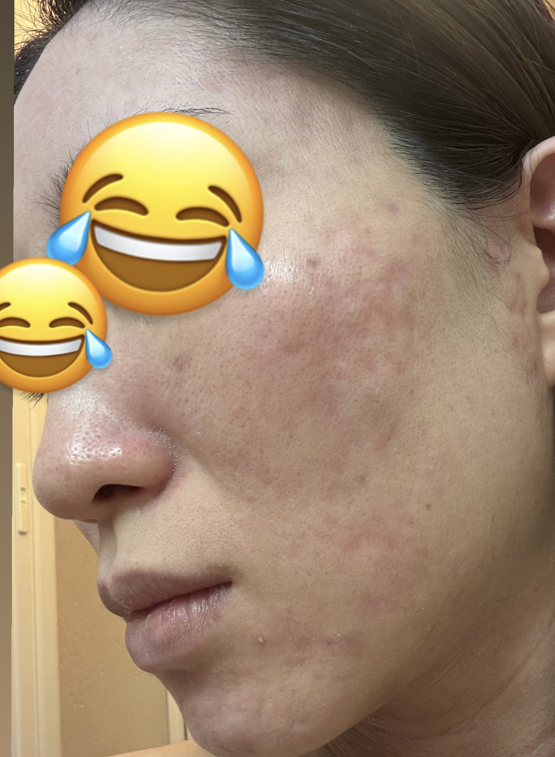 助けてください涙 ニキビ跡の赤みをなくしたいby まお@さんの画像