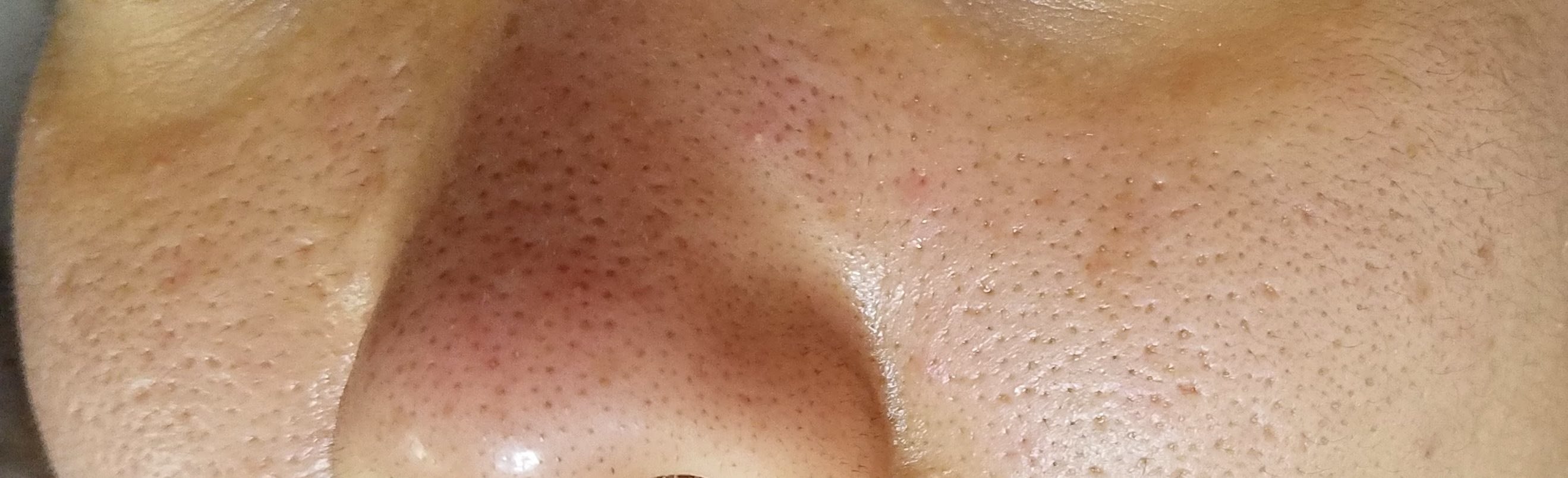 閲覧注意。、毛穴、角栓についてです by 匿名さん の画像