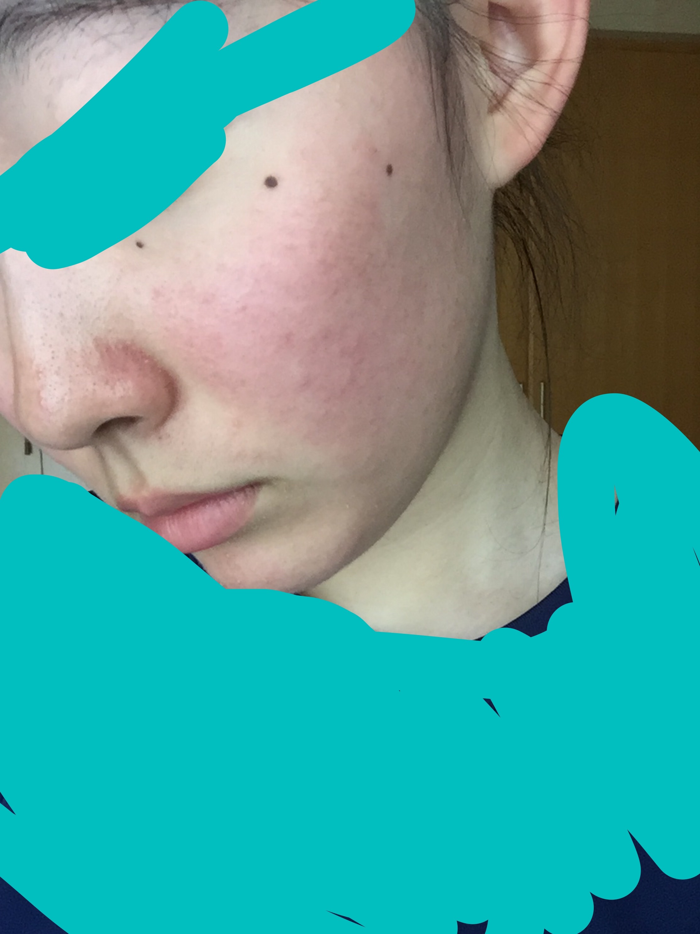 脂漏性皮膚炎 冬くらいからこんな感じで頬や顎が赤く小さ Q A Cosme アットコスメ