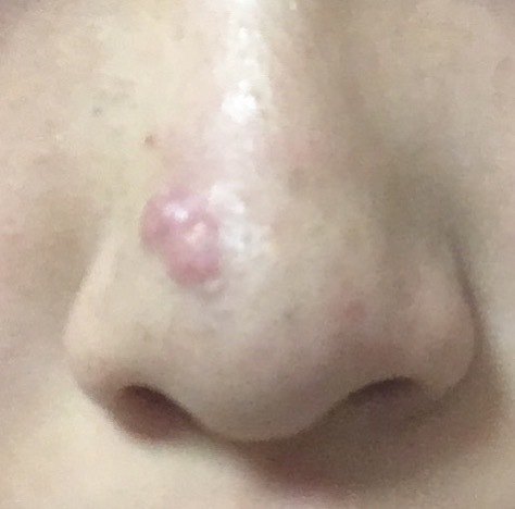 鼻の大きいニキビの治し方を教えてください 2週間近く前 Q A Cosme アットコスメ
