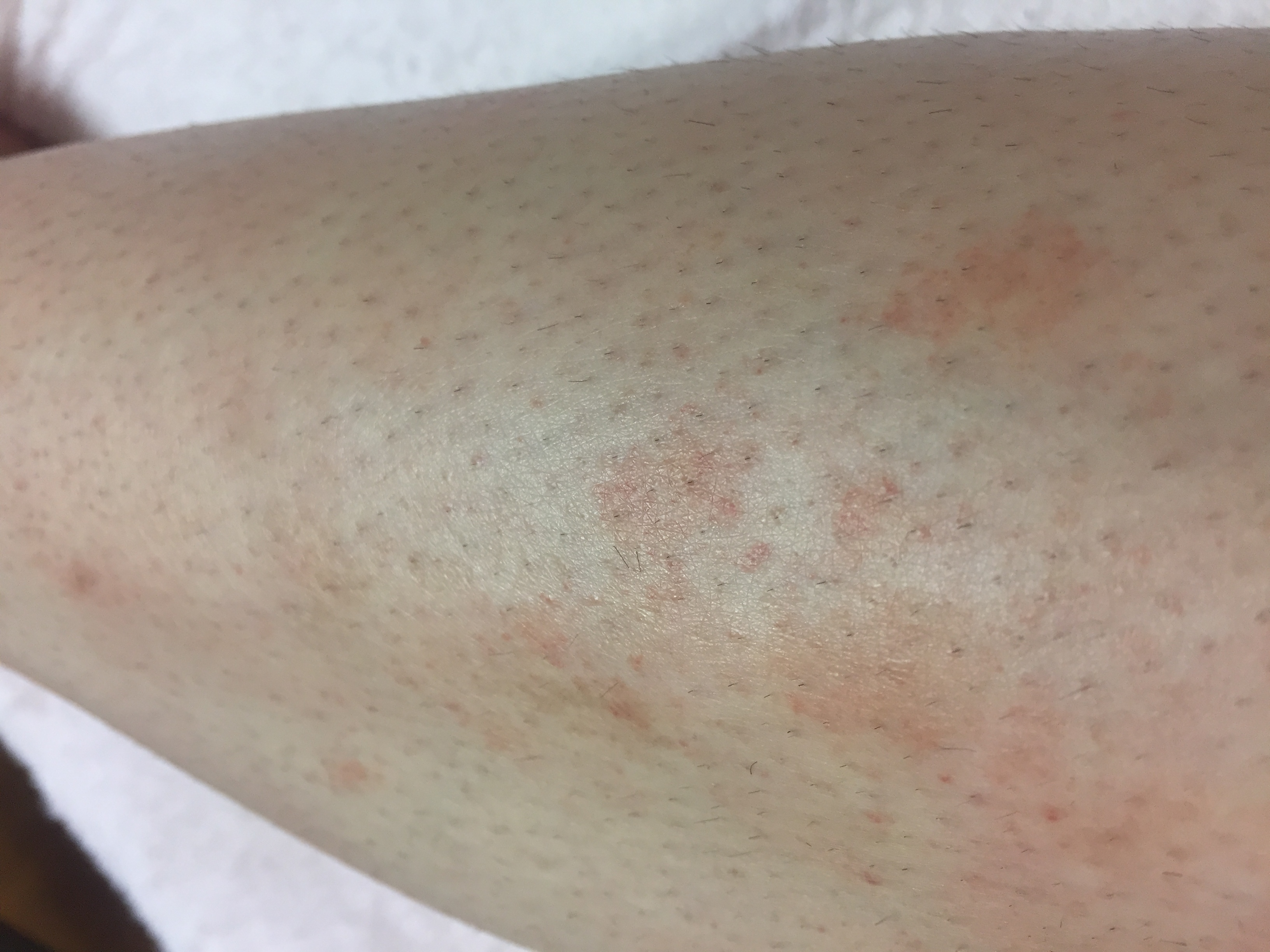 脚の湿疹 数ヶ月前から少しずつ脚の湿疹が広がっています Q A Cosme アットコスメ